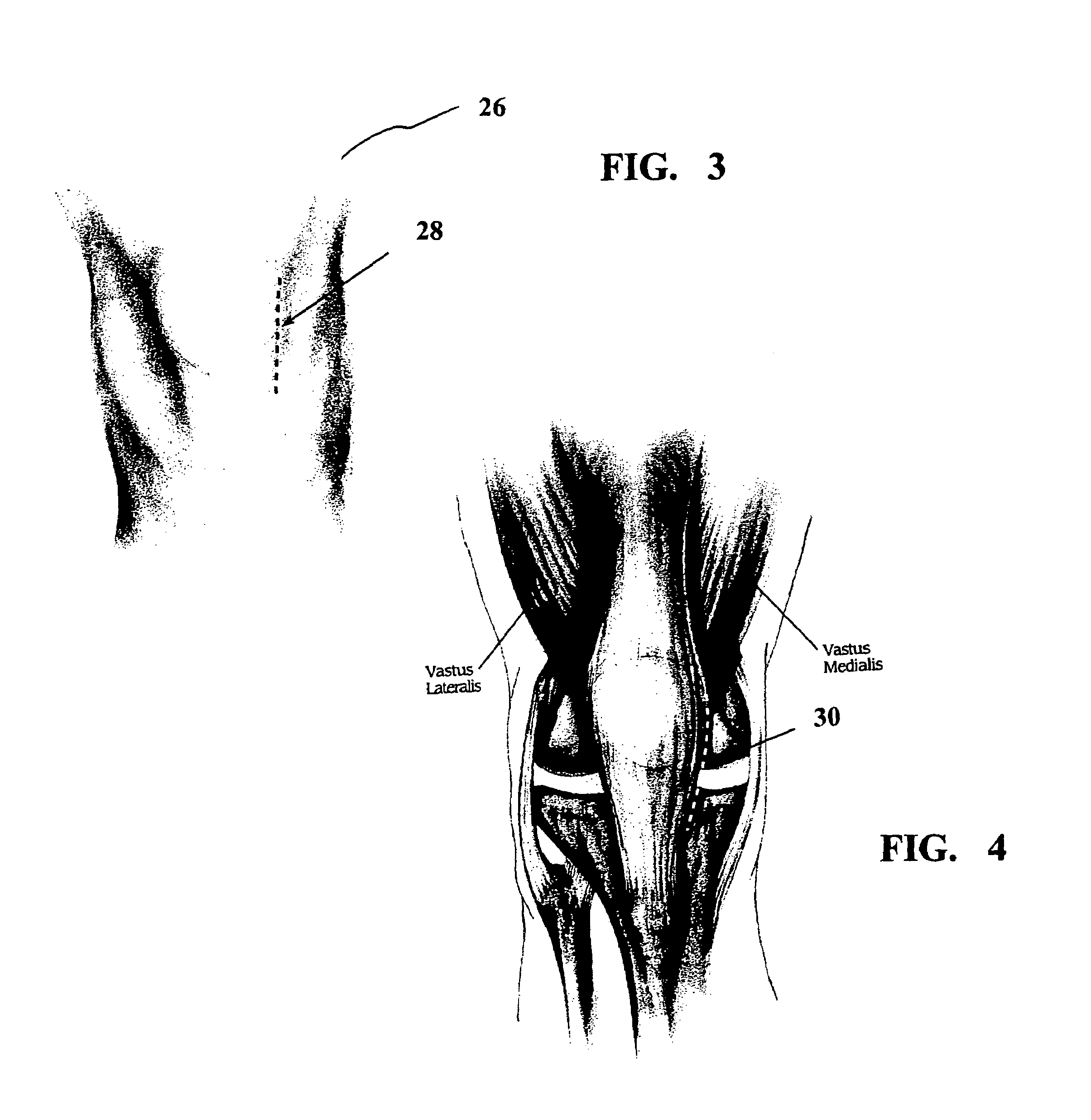 Method and apparatus for achieving correct limb alignment in unicondylar knee arthroplasty