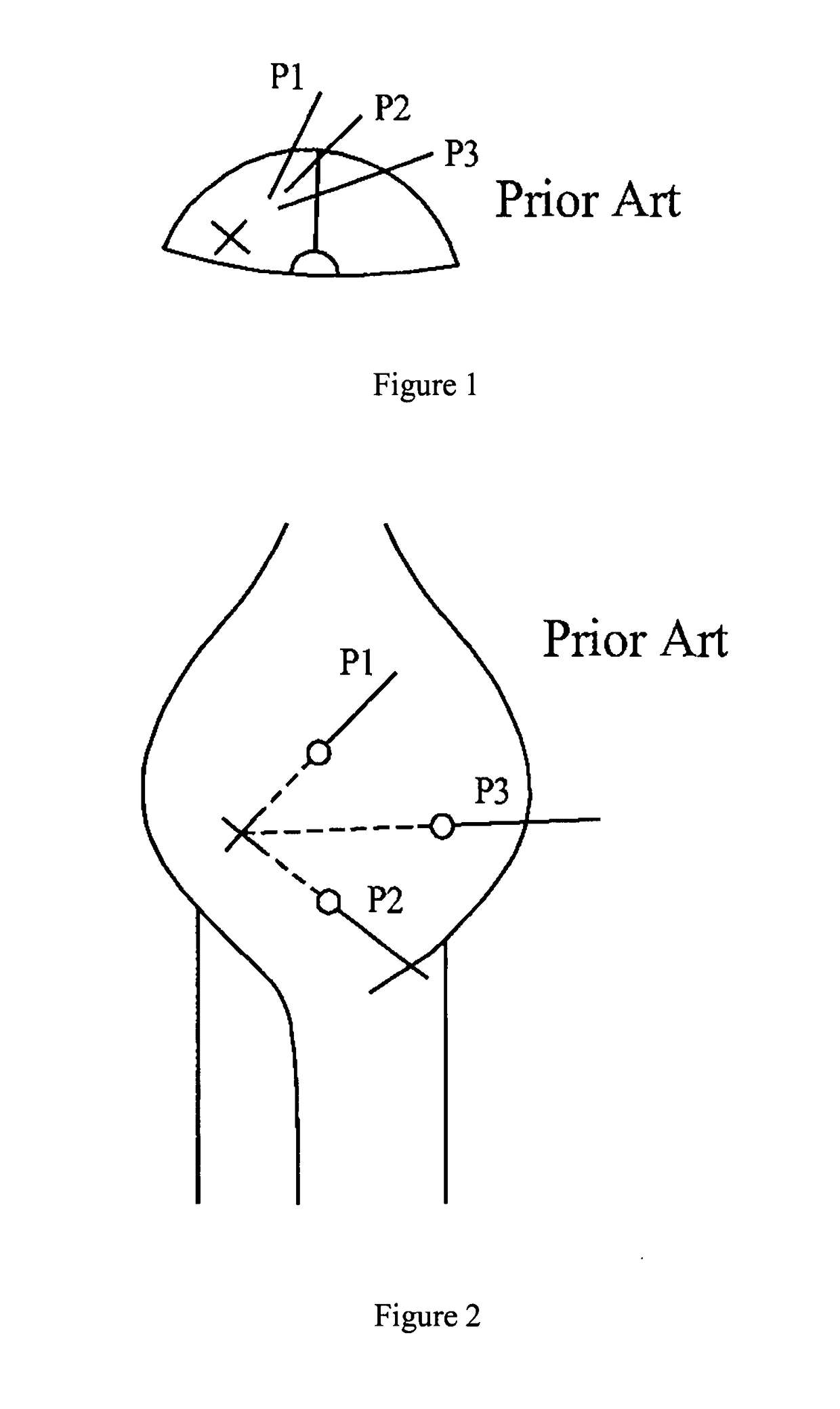 Apparatus and method for minimally invasive surgery