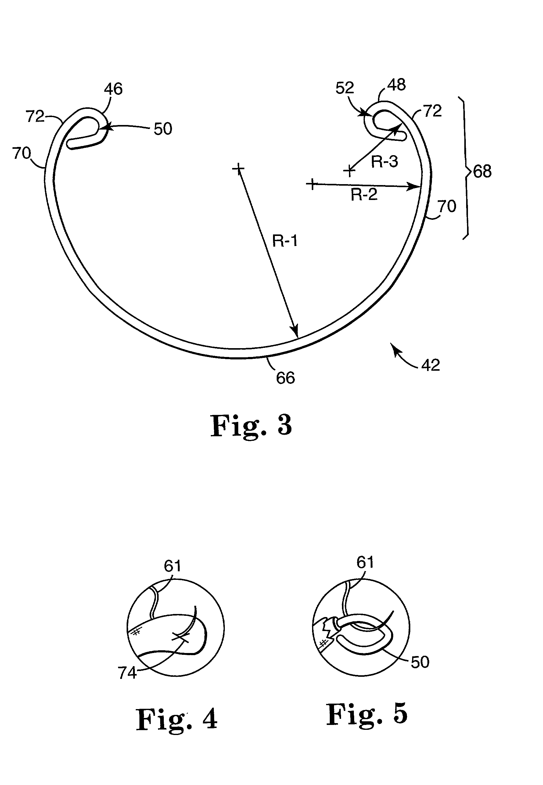 Annuloplasty band and method