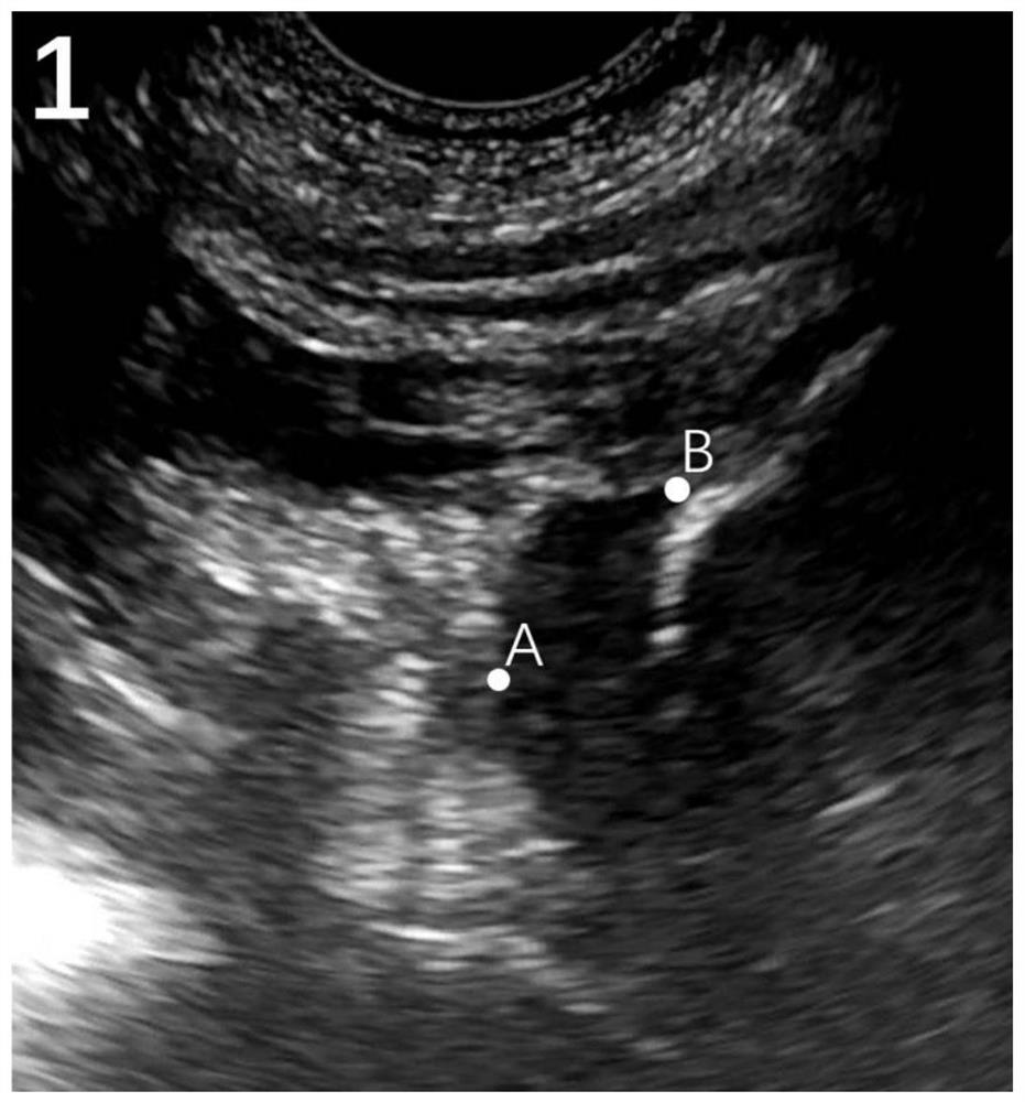 Femoral head localization method, system, device and storage medium in ultrasound image