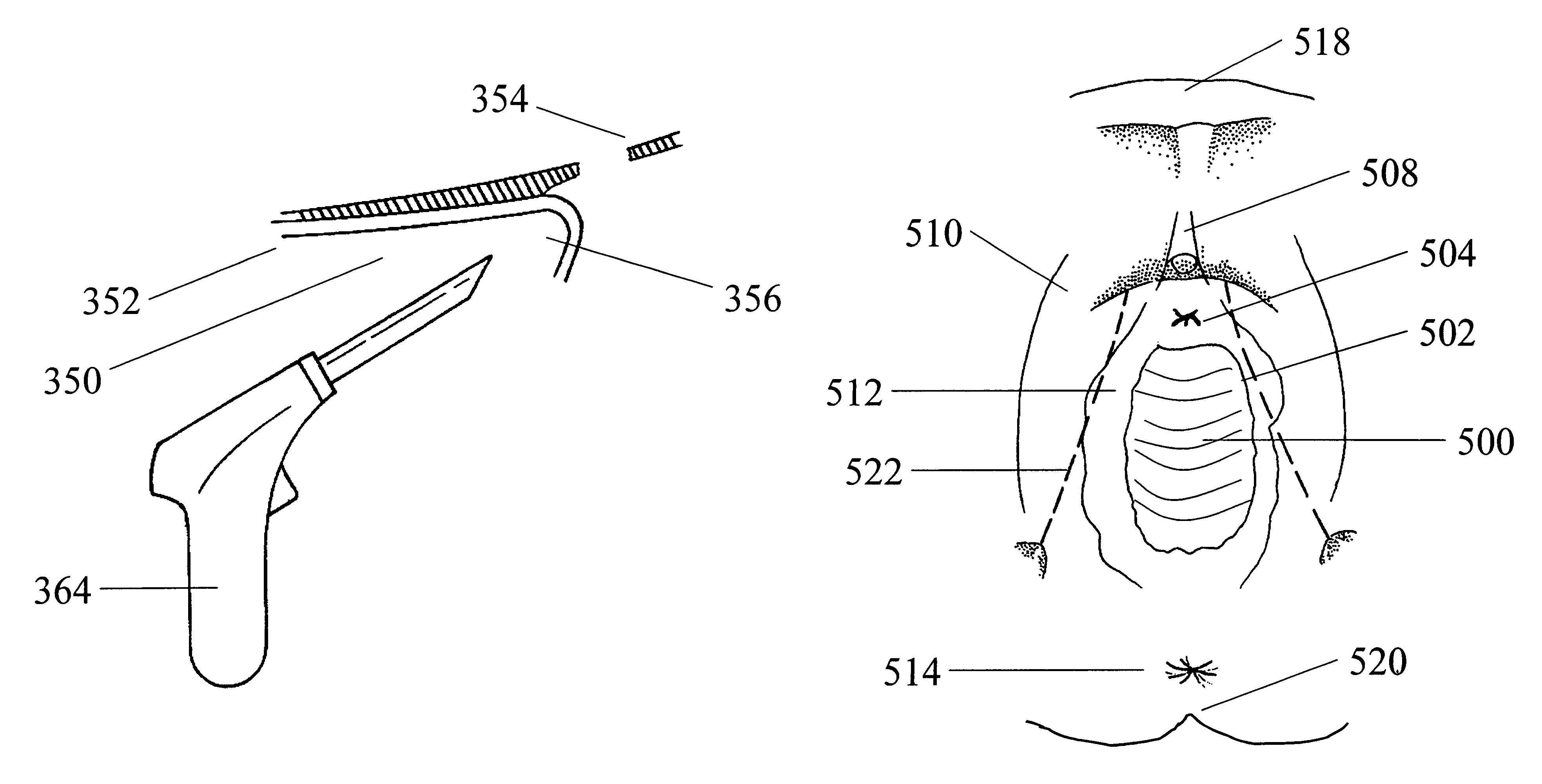 System and methods for soft tissue reconstruction
