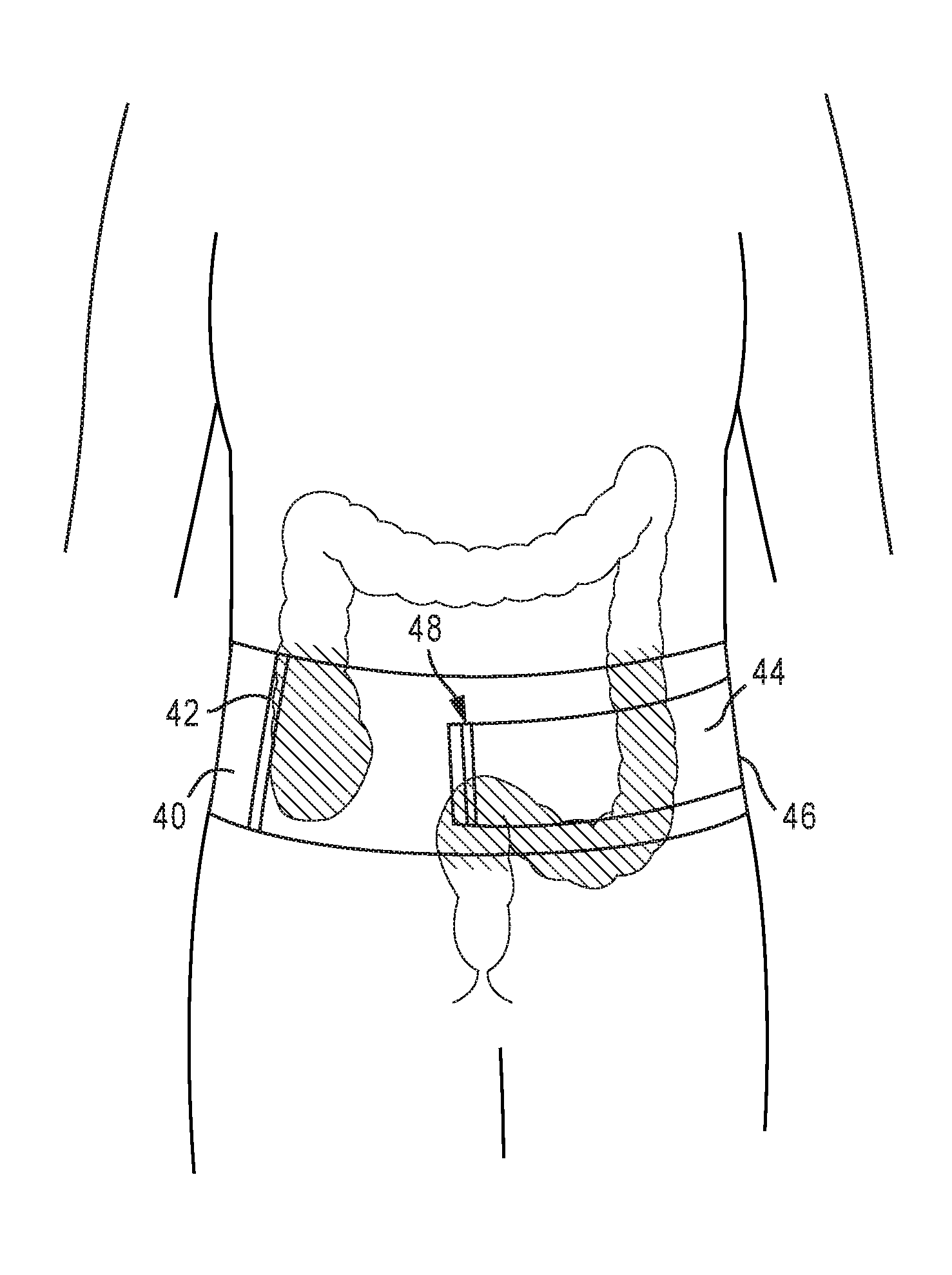 Therapeutic undergarments for the treatment of functional gastrointestinal disorders including irritable bowel syndrome
