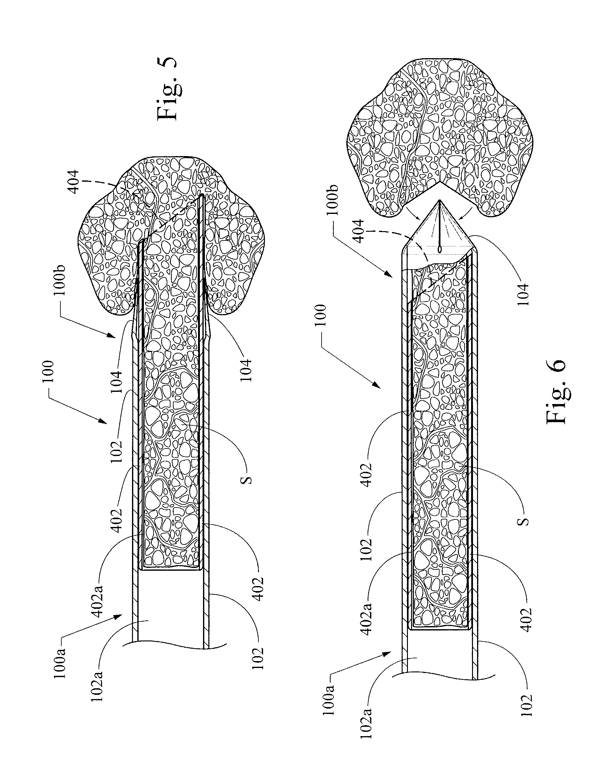 Total core biopsy device and method of use