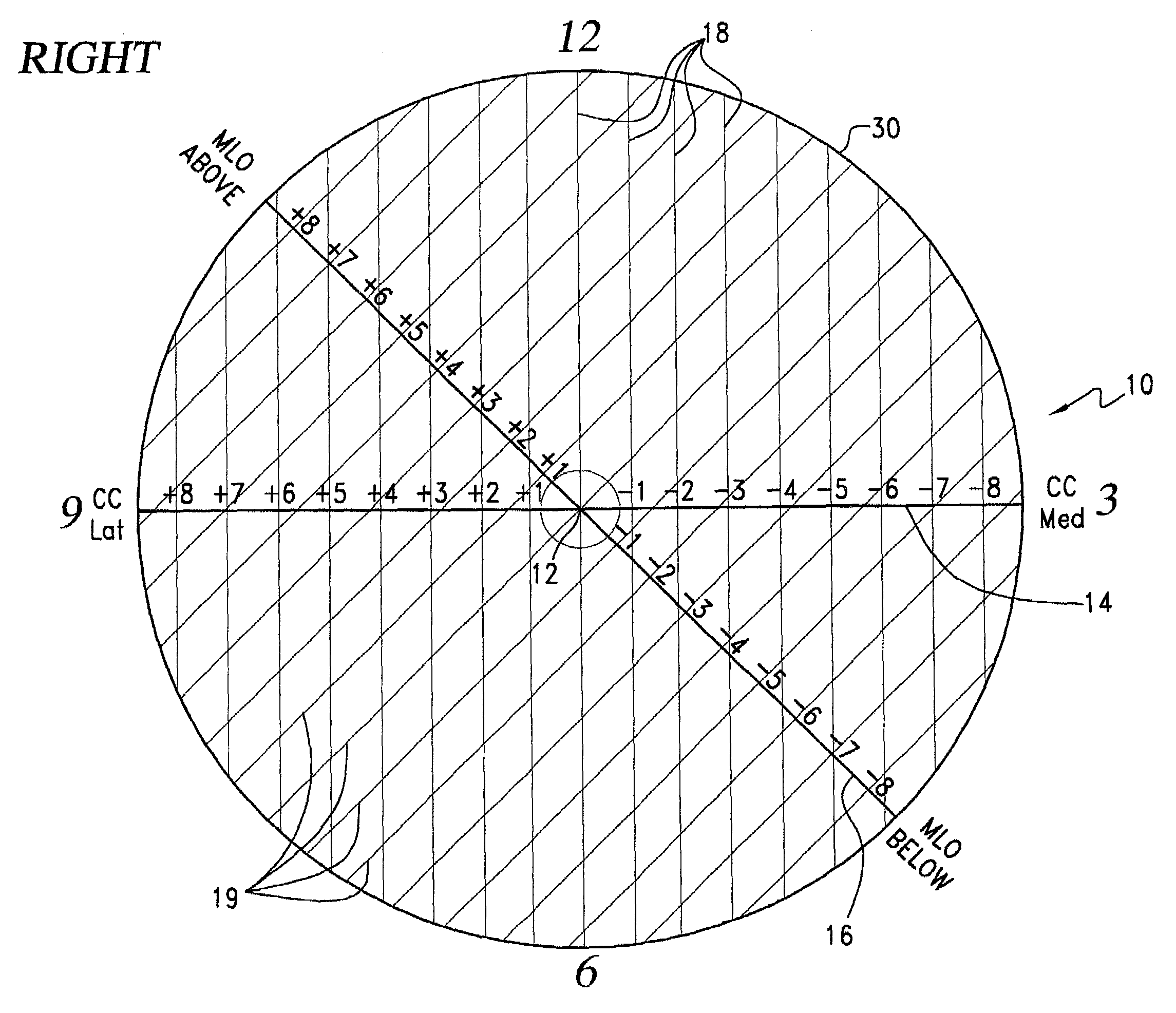 Template for the localization of lesions in a breast and method of use thereof