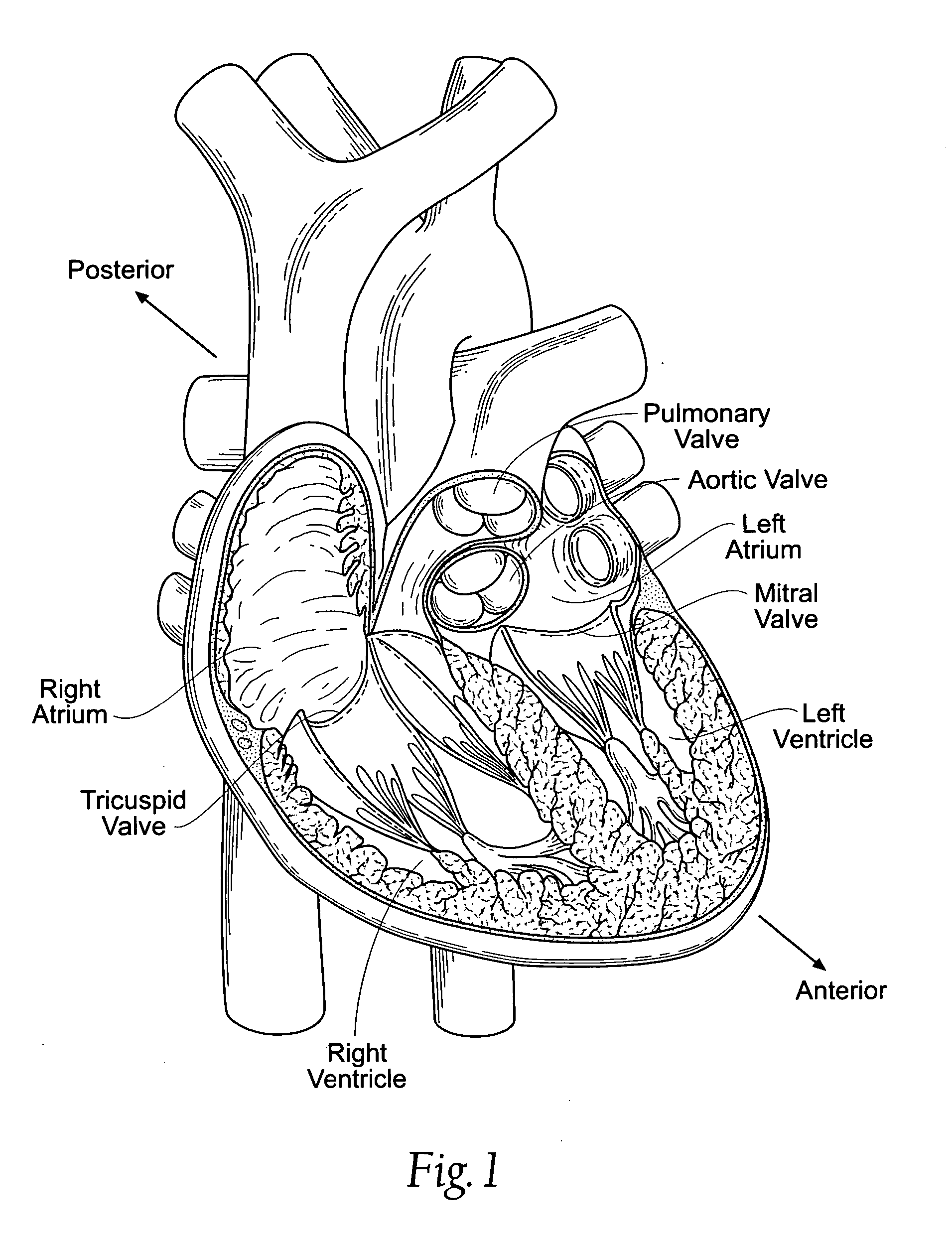 Devices, systems, and methods for reshaping a heart valve annulus