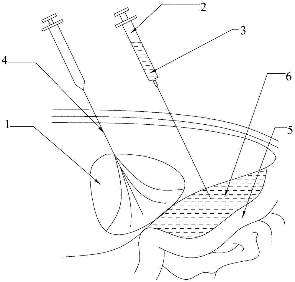 Application of thermosensitive material in preparation of injection for protecting organ peripheral structure in thermal ablation