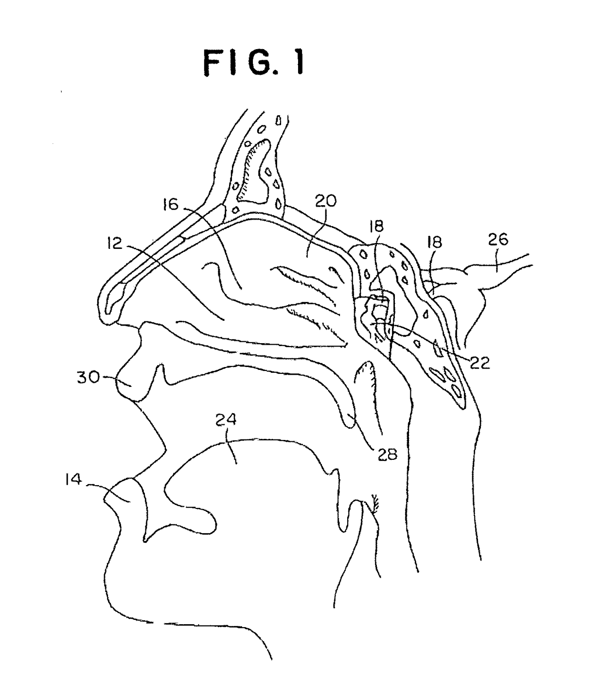 Materials and methods for treating neuropathies and related disorders including those involving a keystone nerve