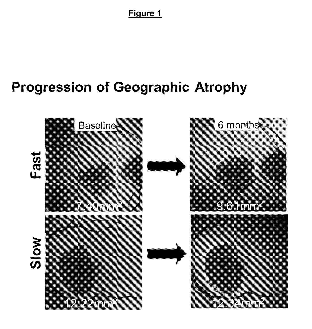 Impact of genetic factors on disease progression and response to Anti-c5 antibody in geographic atrophy