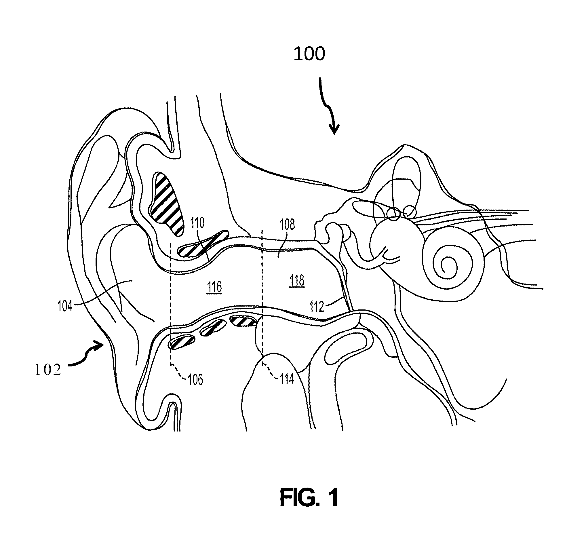 Methods and devices for attenuating sound in a conduit or chamber
