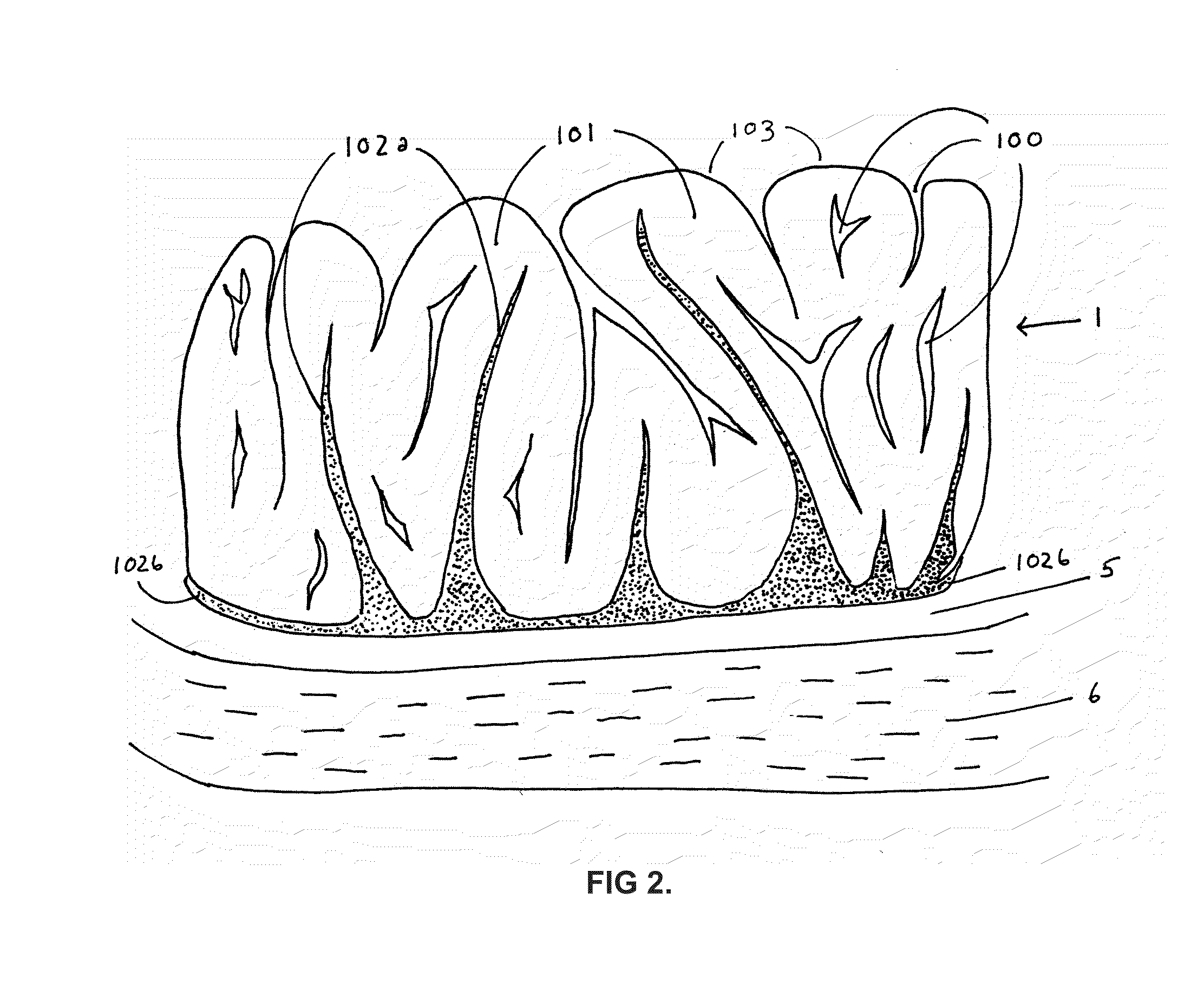 Photothermal treatment of soft tissues