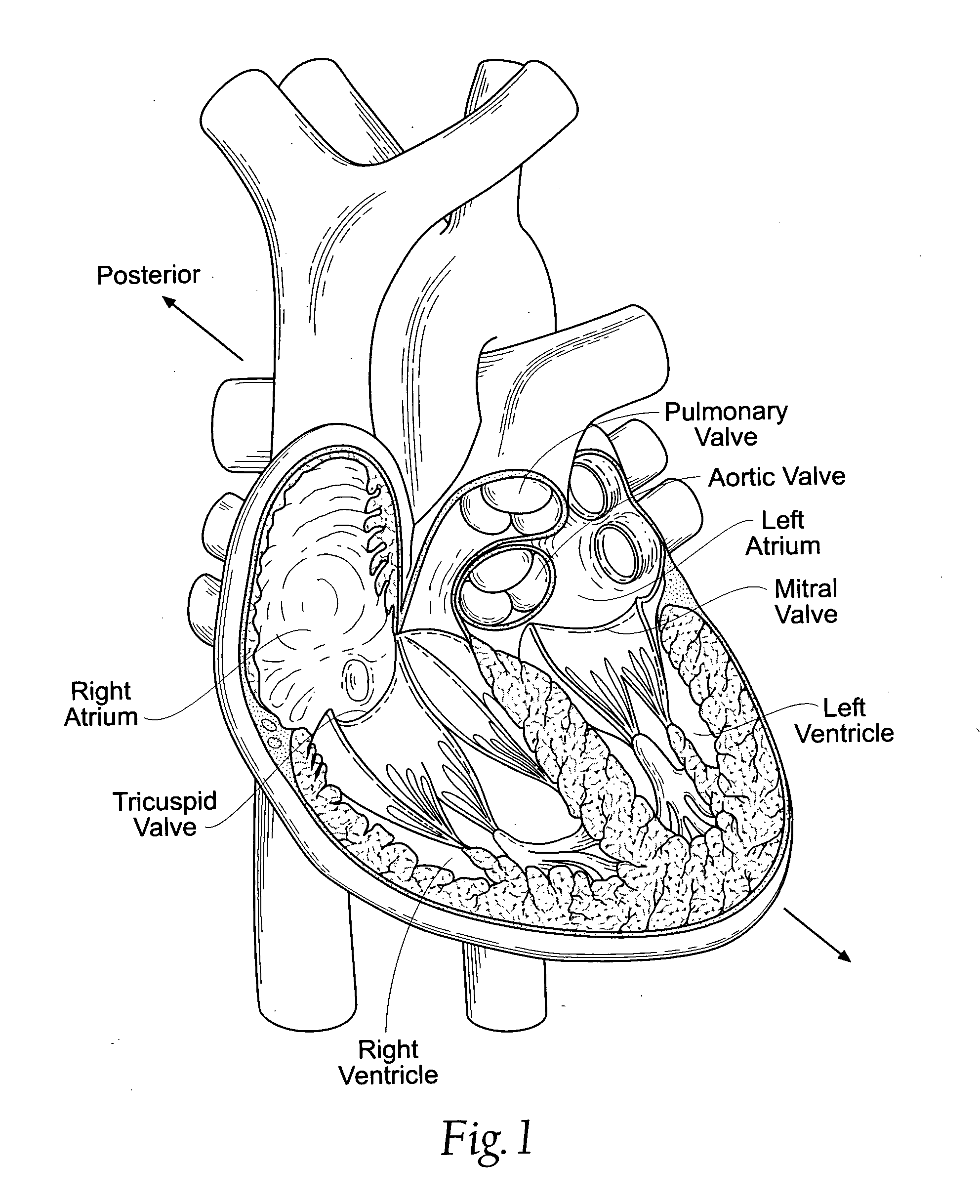 Suspended heart valve devices, systems, and methods for supplementing, repairing, or replacing a native heart valve