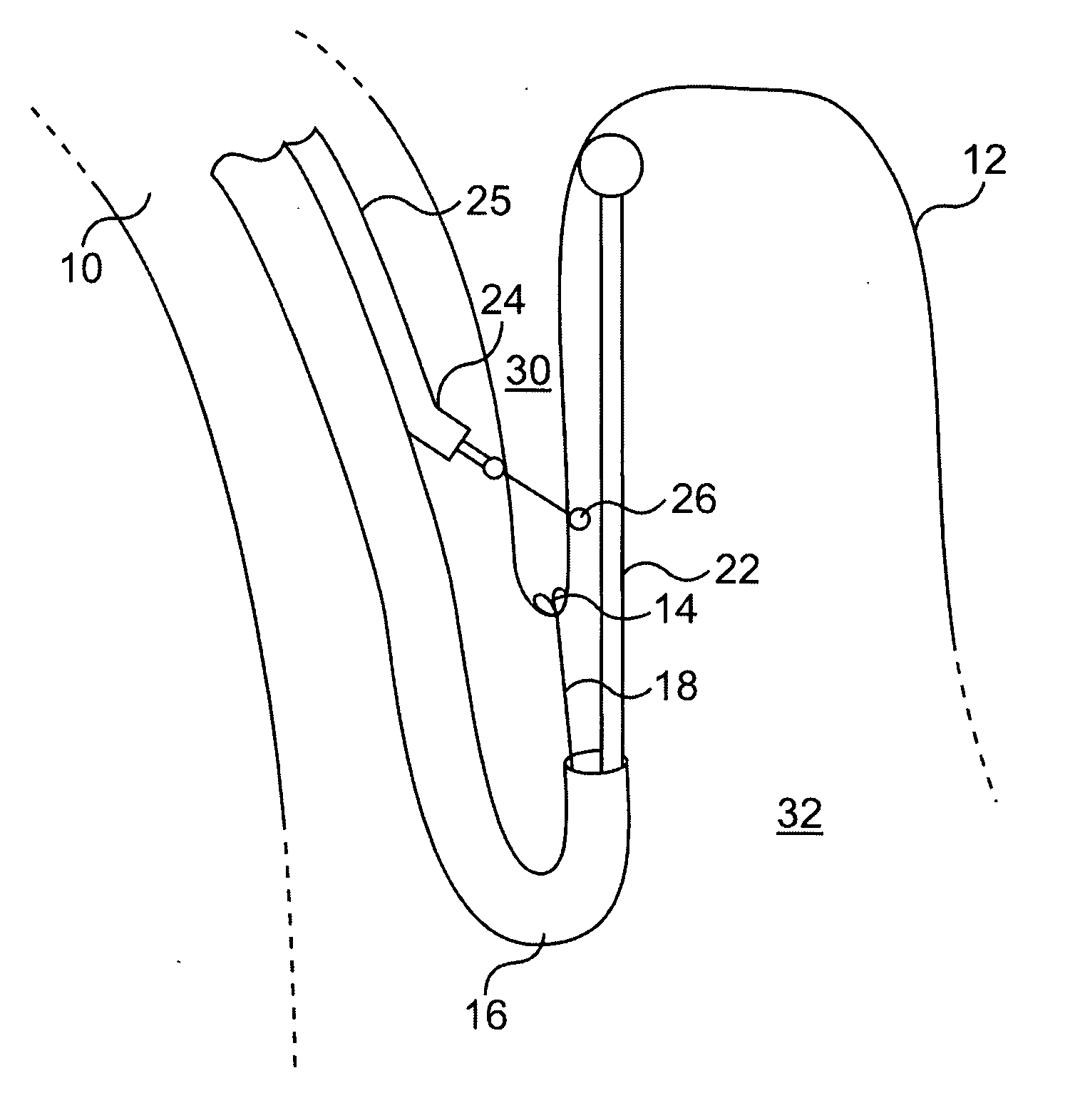 Method for performing endoluminal fundoplication and apparatus for use in the method