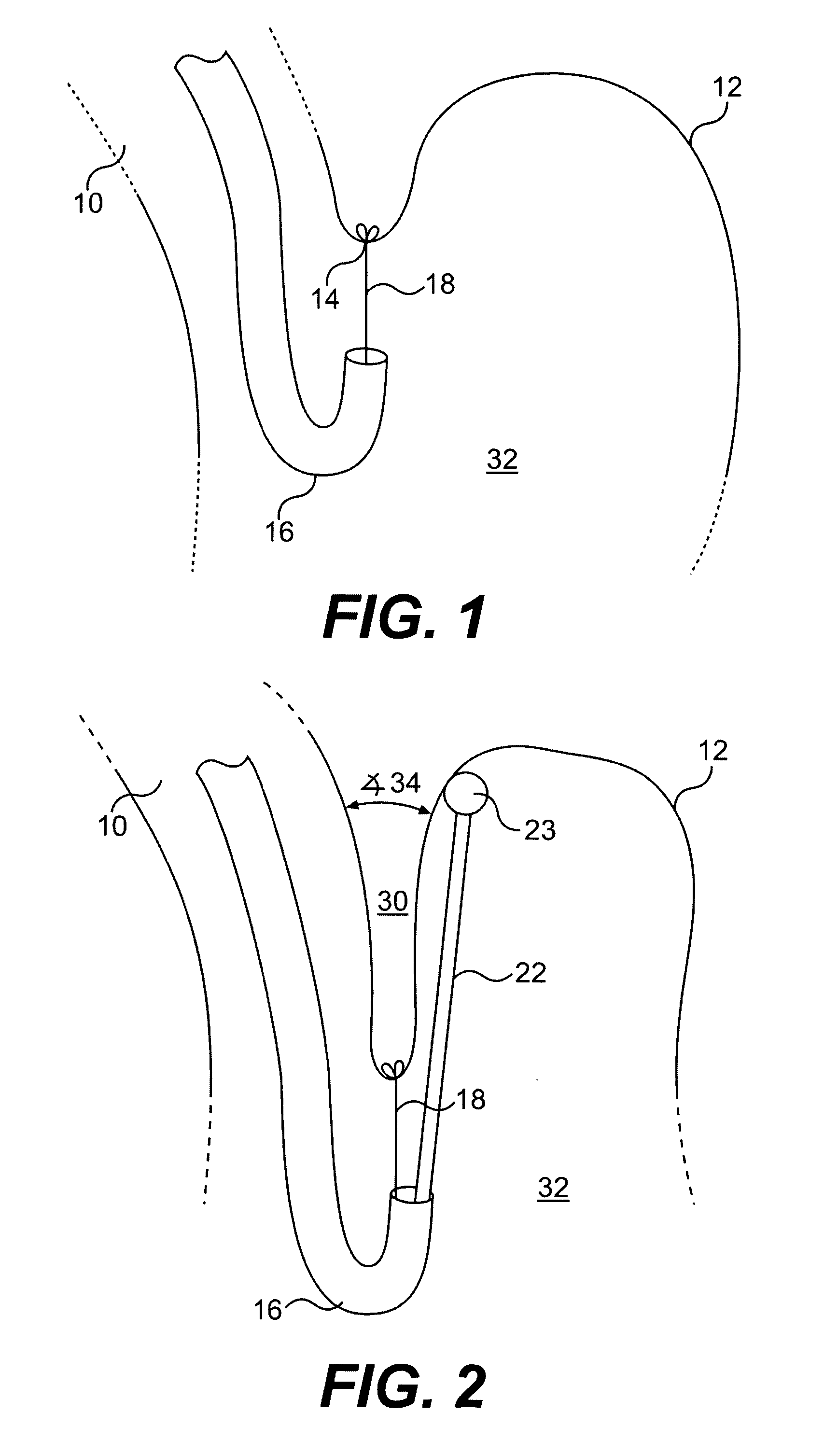 Method for performing endoluminal fundoplication and apparatus for use in the method