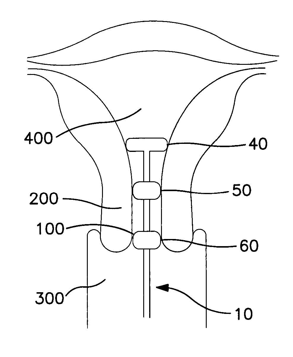 Fluid-filled cervical dilator