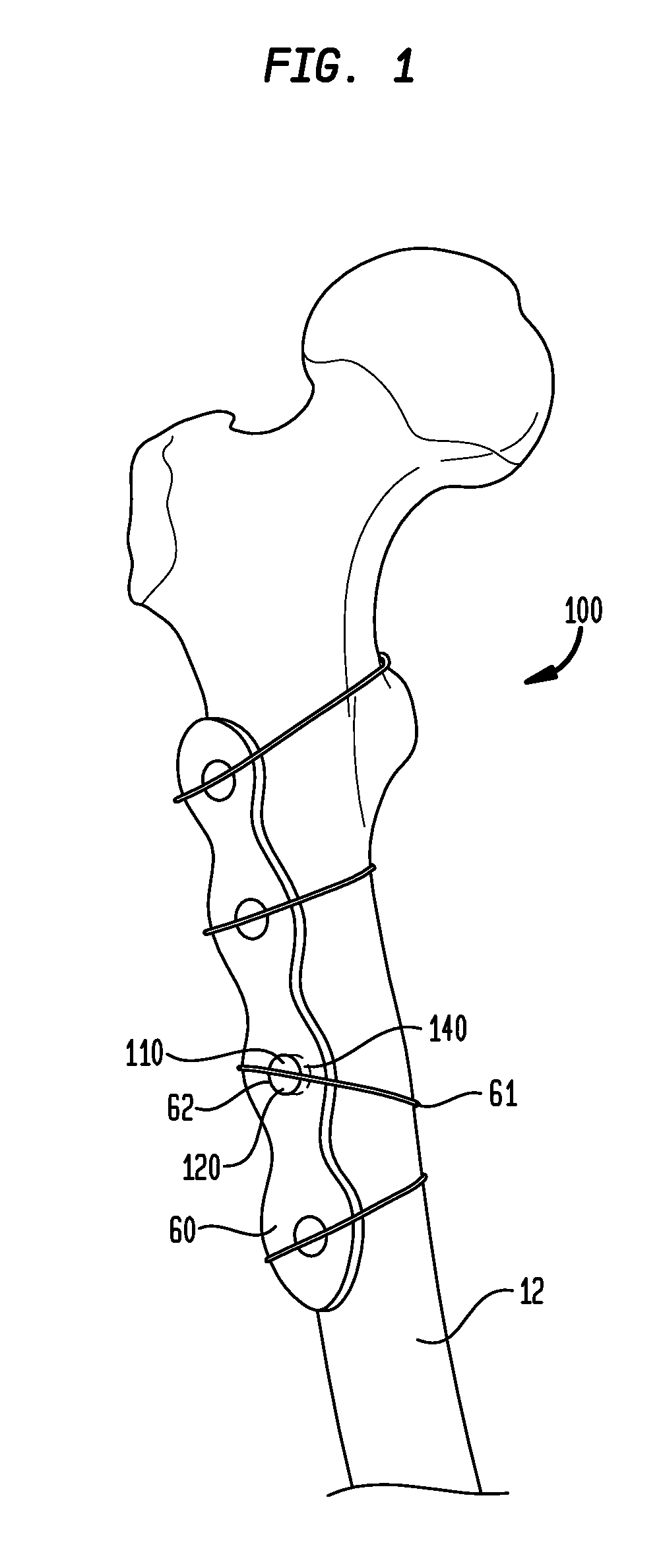 Cable plugs for bone plates