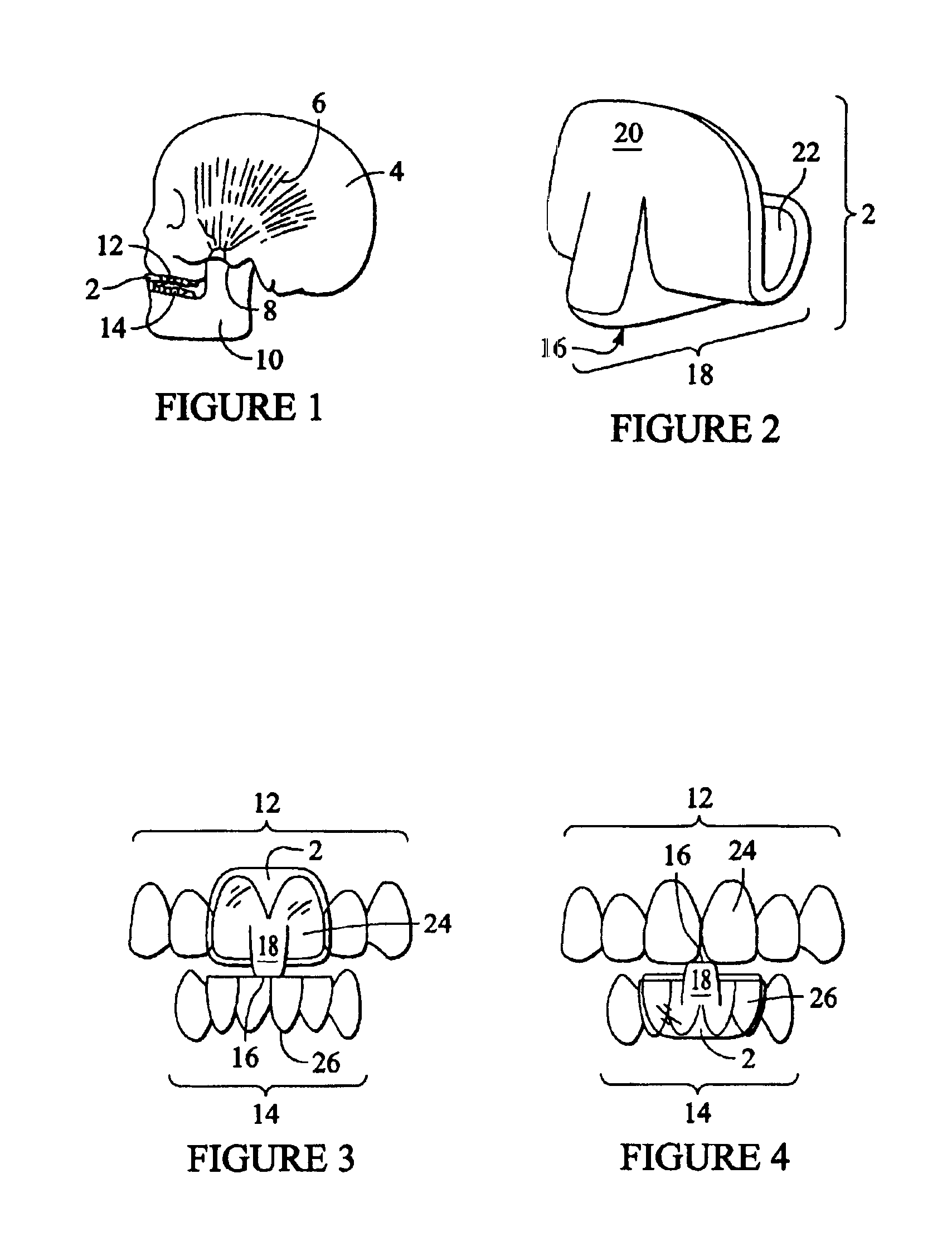 Intraoral discluder device and method for preventing migraine and tension headaches and temporomandibular disorders