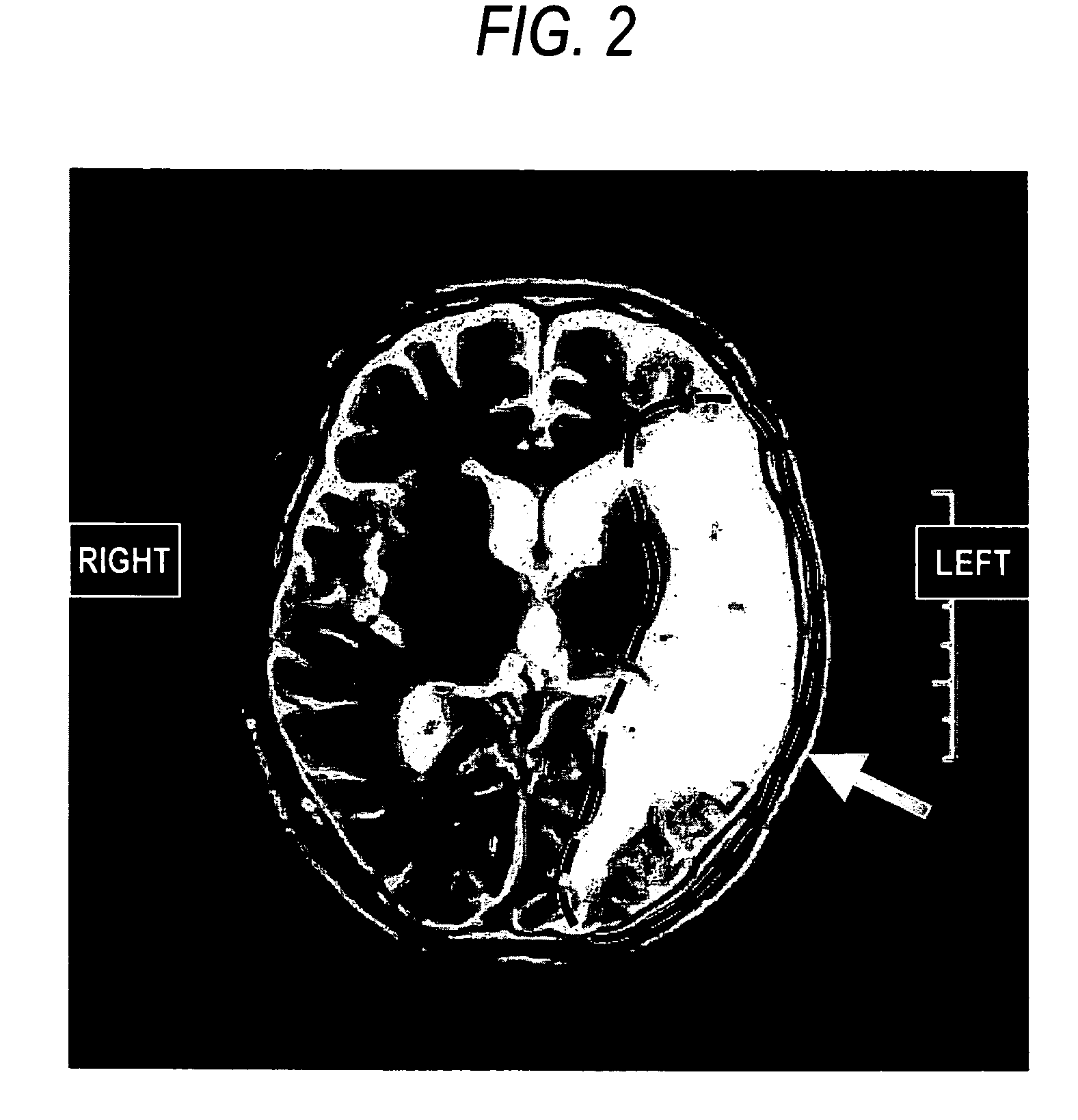Agent or method for treating severe aphasia in cerebrovascular accident chronic stage