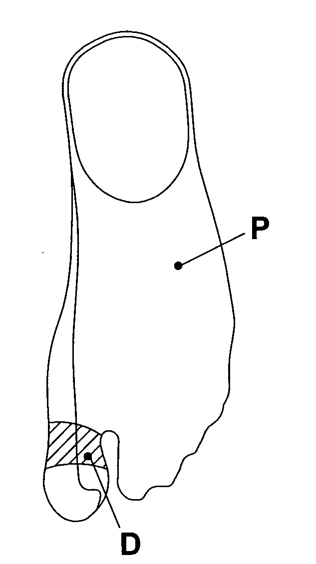 Reinforced stocking or sock for the prevention and/or treatment of hallux valgus