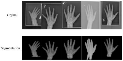 Bone age evaluation method for realizing image segmentation and classification based on deep learning