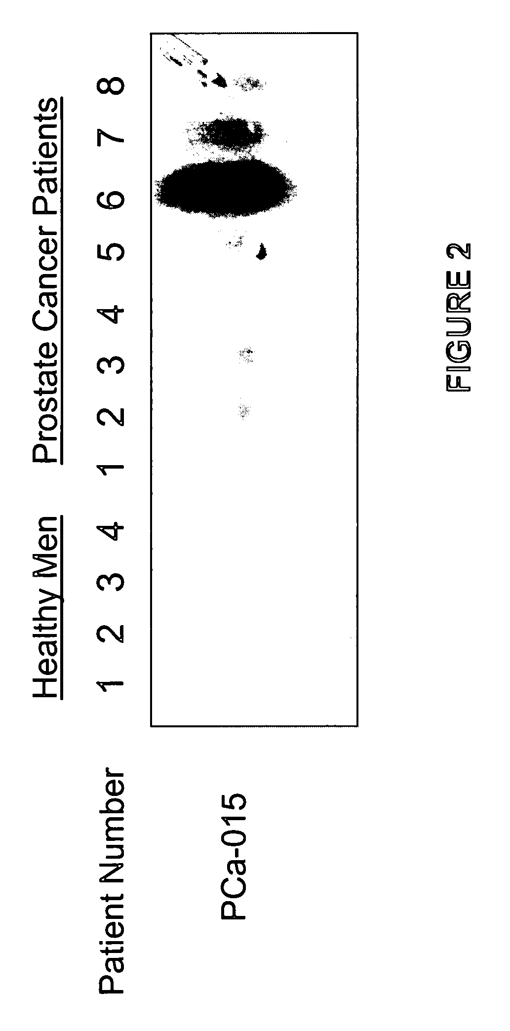 Methods of providing gene expression profiles for metastatic cancer phenotypes utilizing differentially expressed transcripts associated with circulating tumor cells