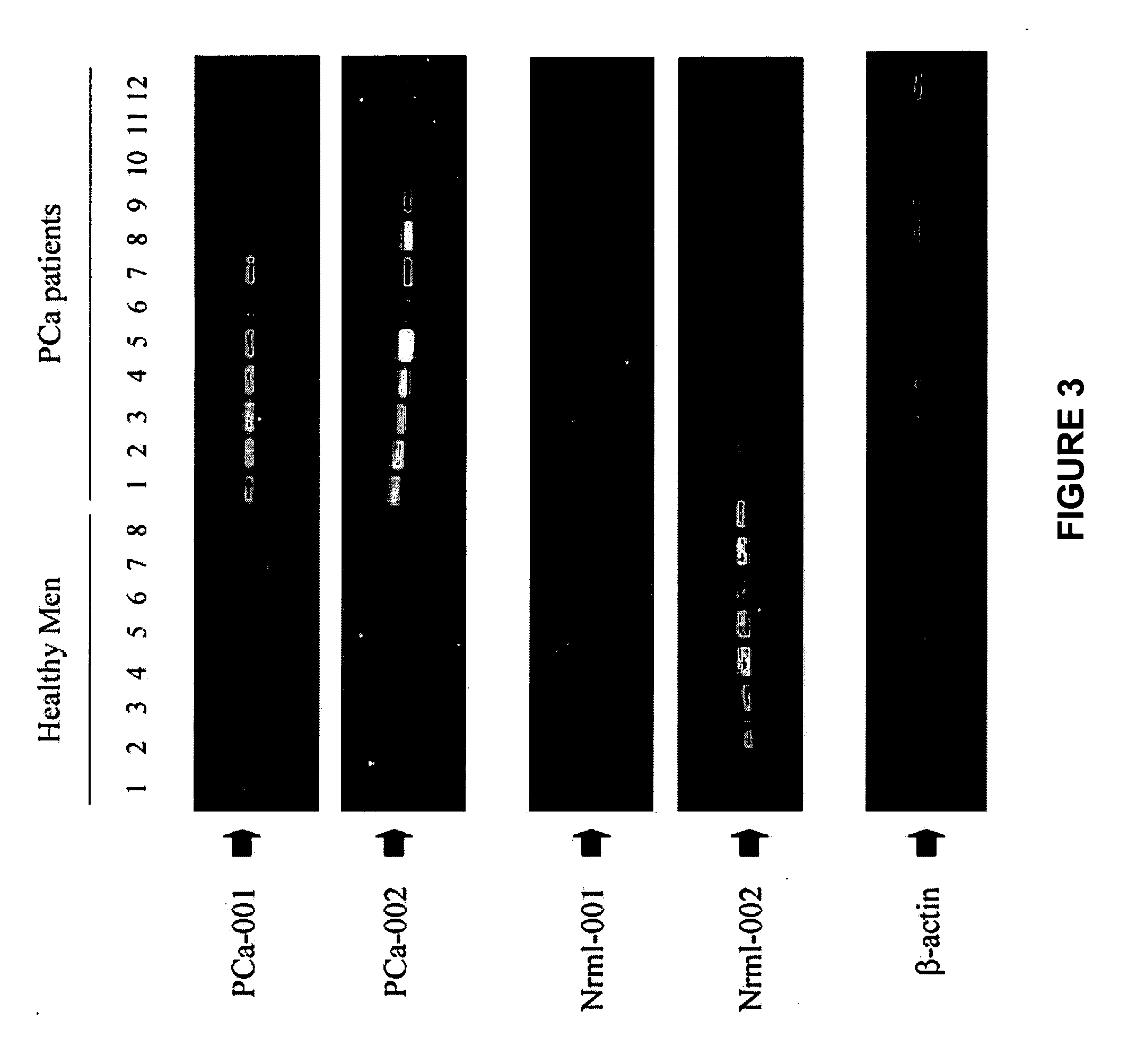 Methods of providing gene expression profiles for metastatic cancer phenotypes utilizing differentially expressed transcripts associated with circulating tumor cells