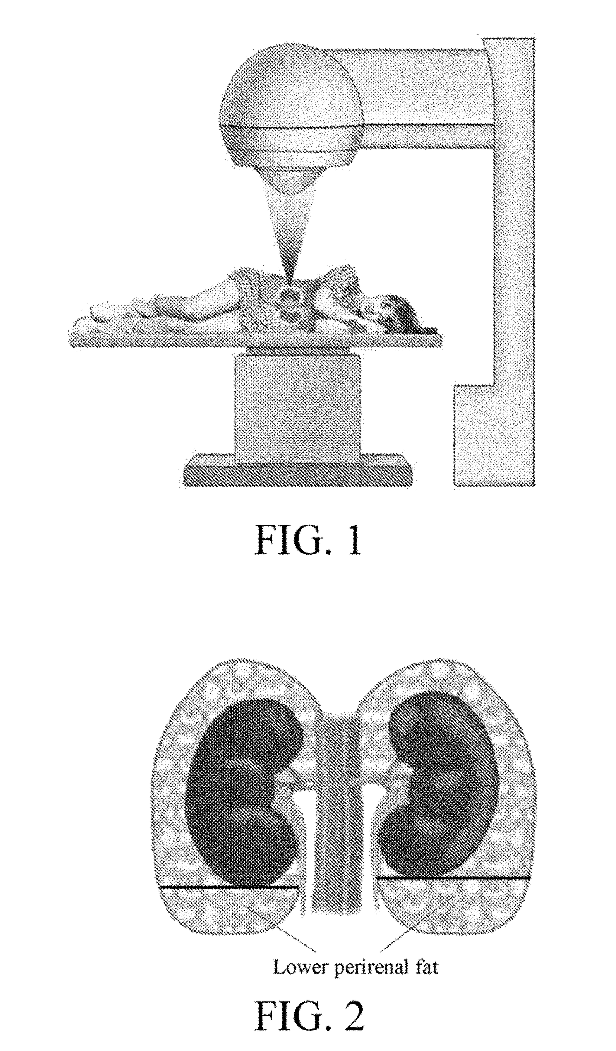 Application of high-intensity focused ultrasound system to treatment of essential hypertension