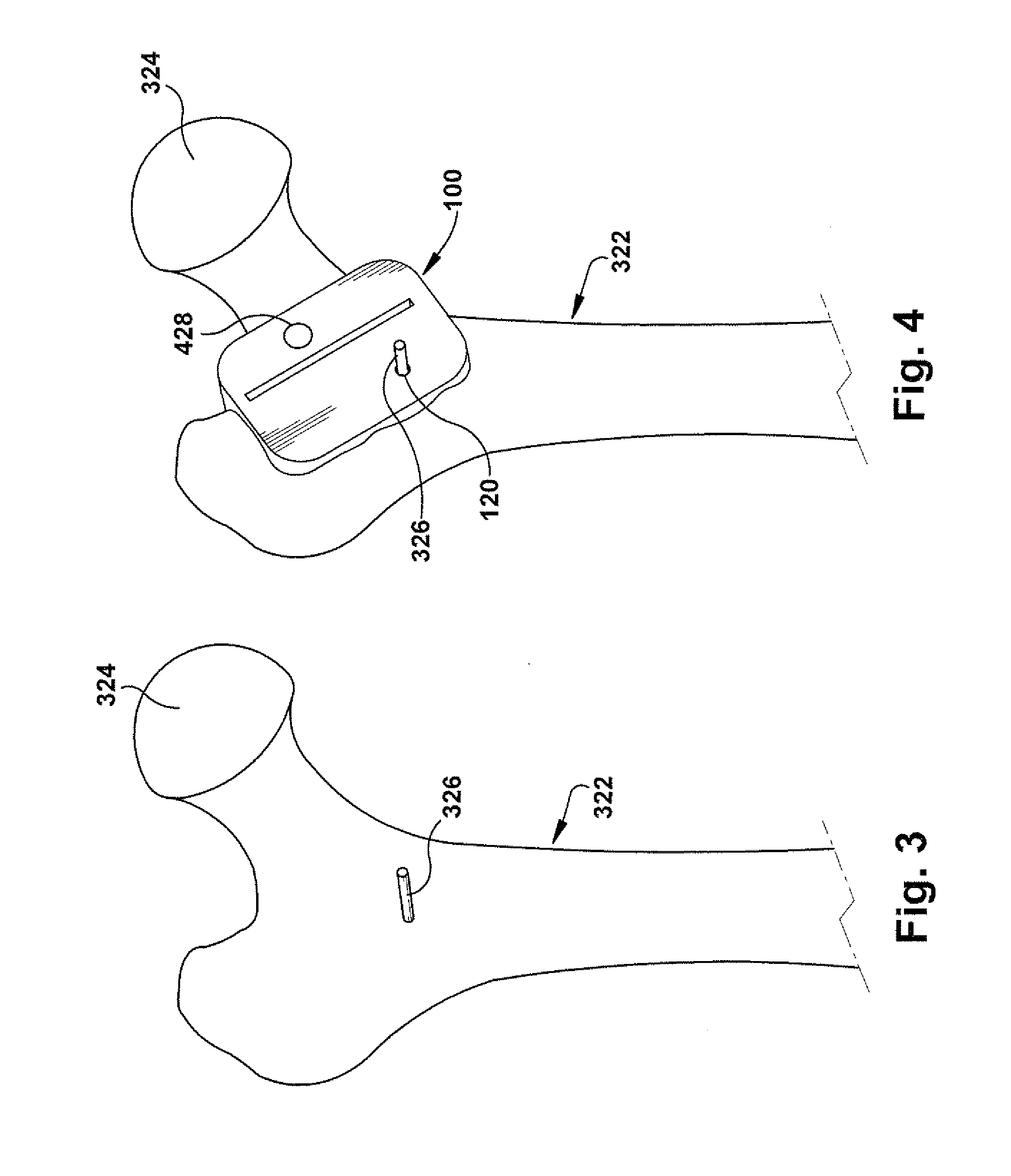 Positioning apparatus and method for a prosthetic implant