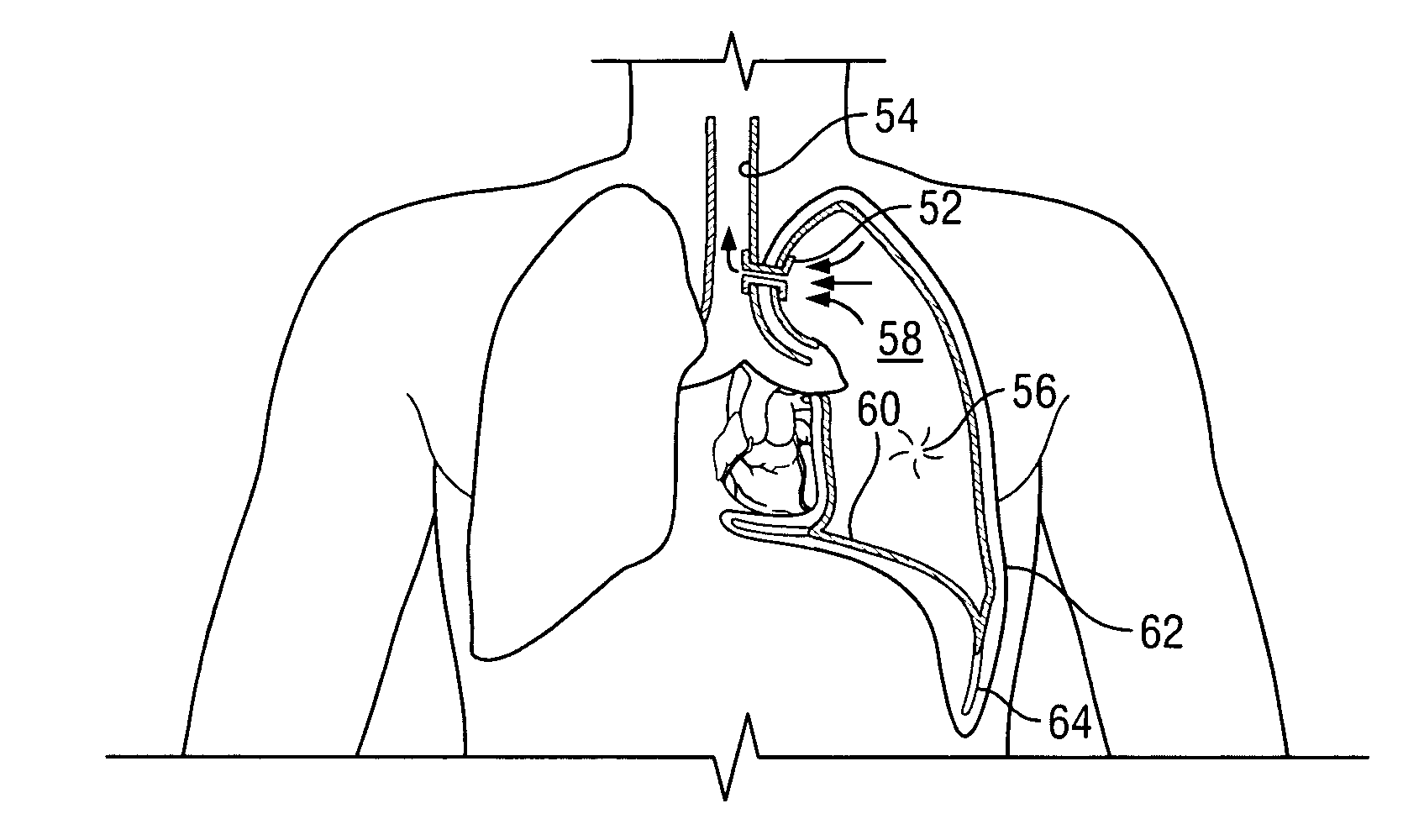 Extrapleural airway device and method