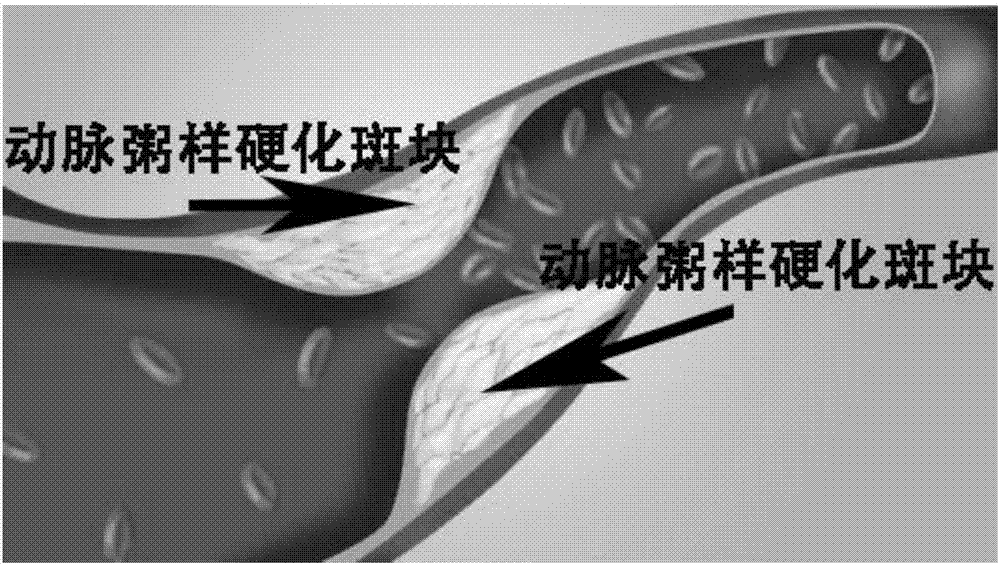 Modeling method for new blood vessels in abdominal aorta atherosclerotic plaques of New Zealand white rabbit