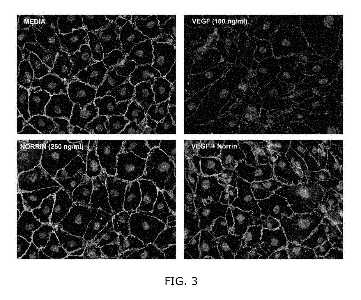 Norrin regulation of junction proteins and the use thereof to treat epithelial or endothelial membrane leakage induced edema