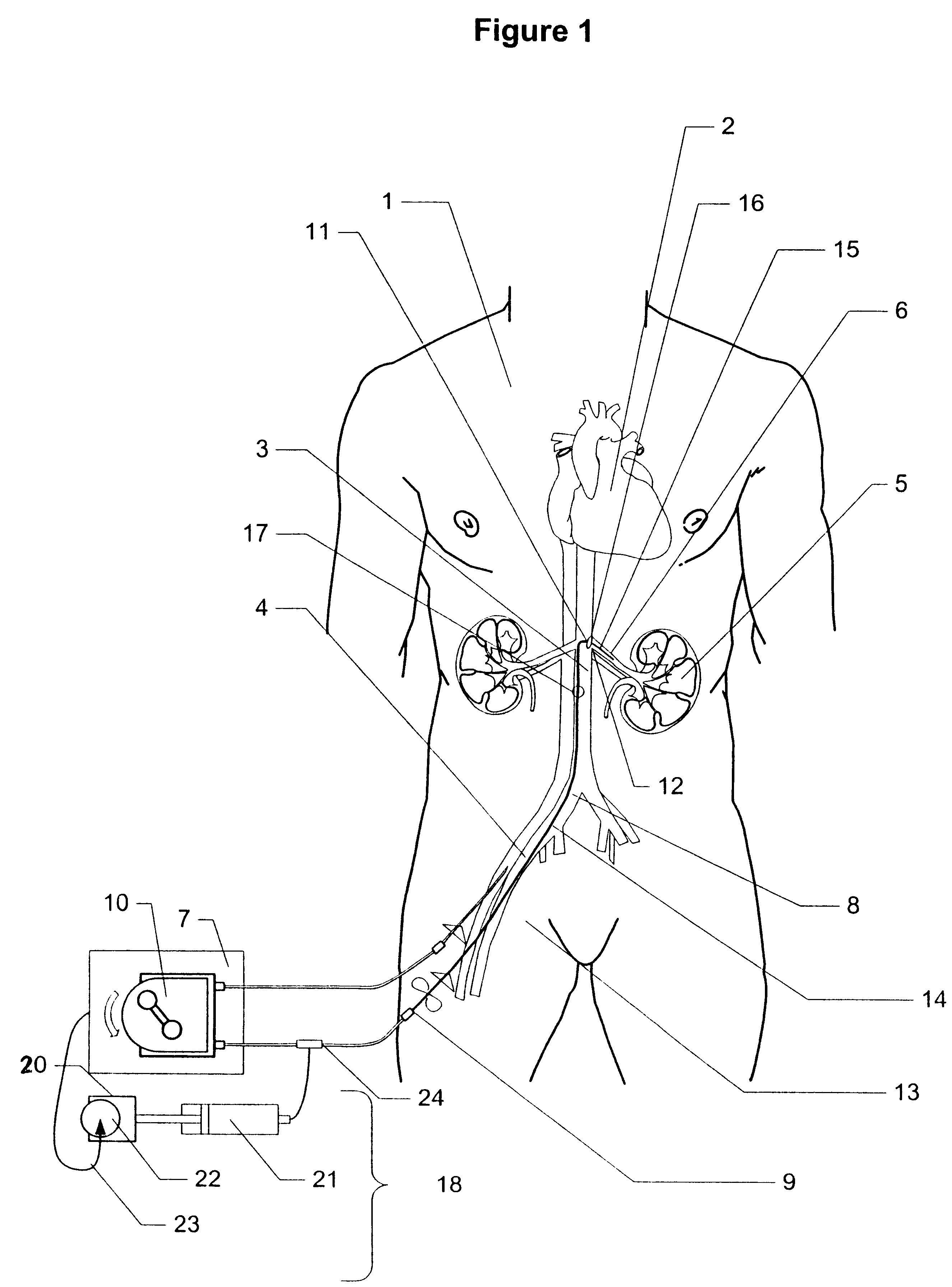 Method and apparatus for treatment of congestive heart failure by improving perfusion of the kidney by infusion of a vasodilator