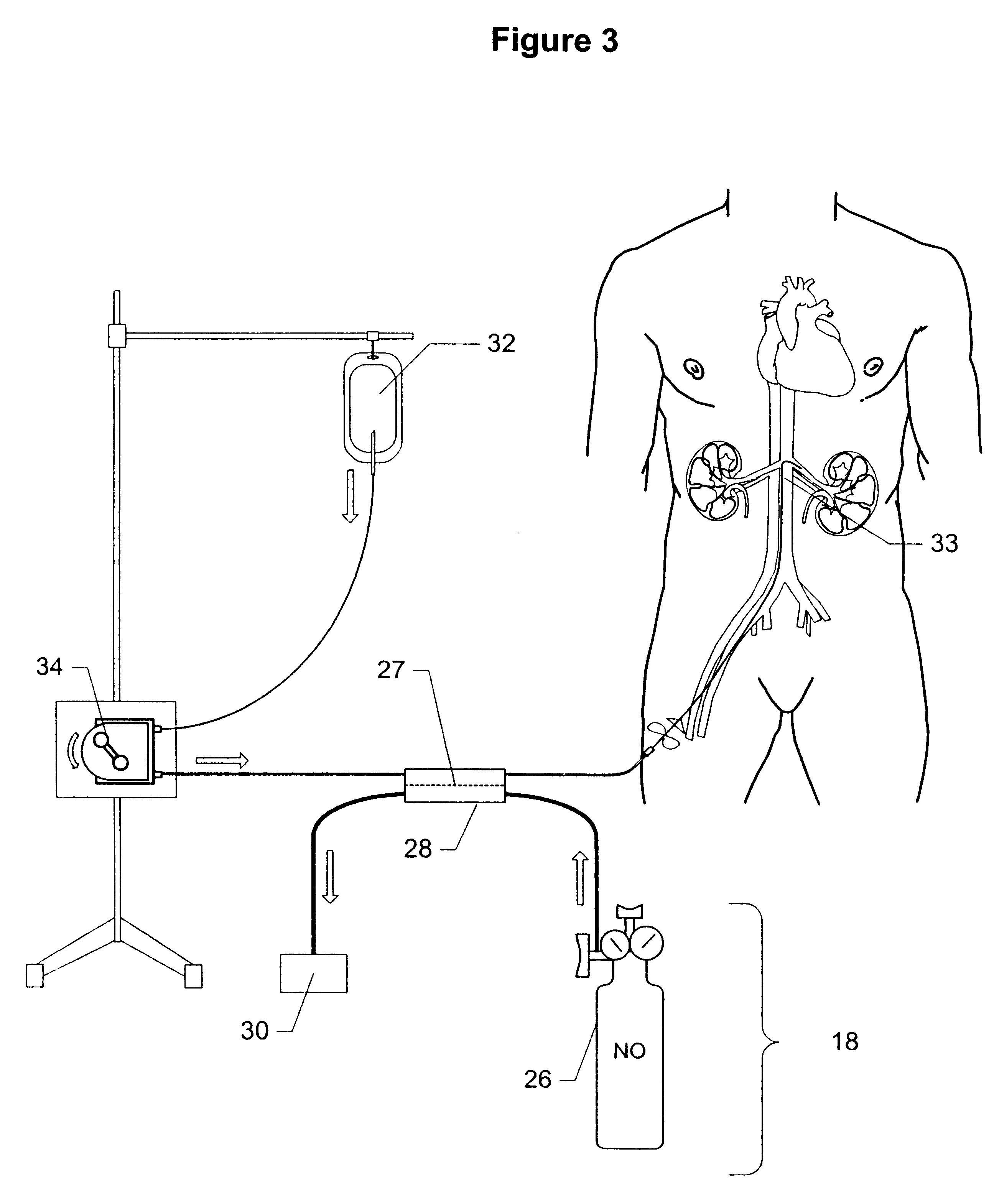 Method and apparatus for treatment of congestive heart failure by improving perfusion of the kidney by infusion of a vasodilator