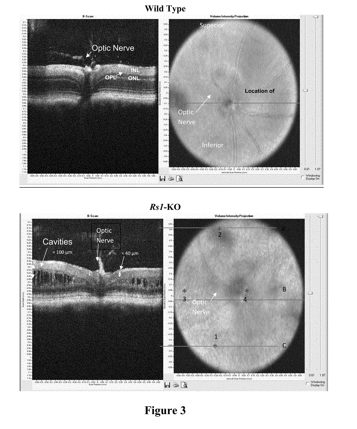 Methods and compositions for treating genetically linked diseases of the eye