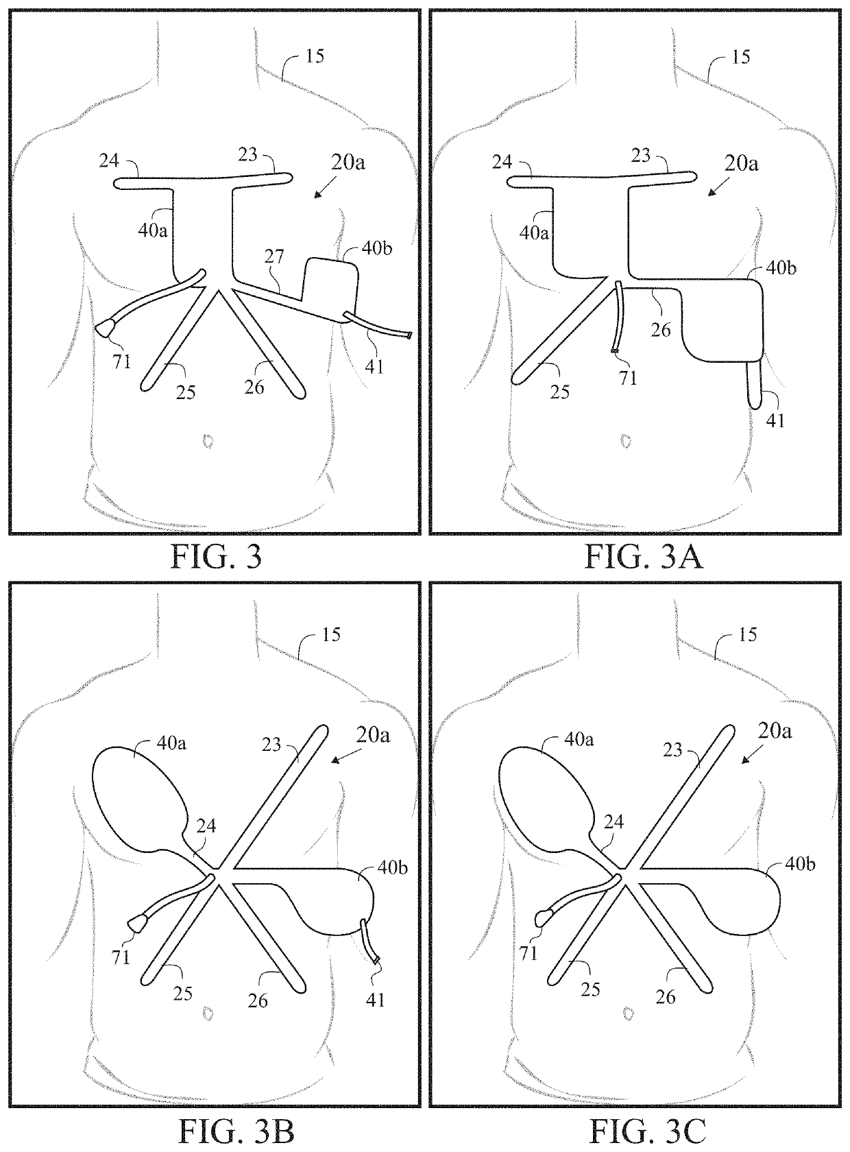 Emergency cardiac and electrocardiogram electrode placement system