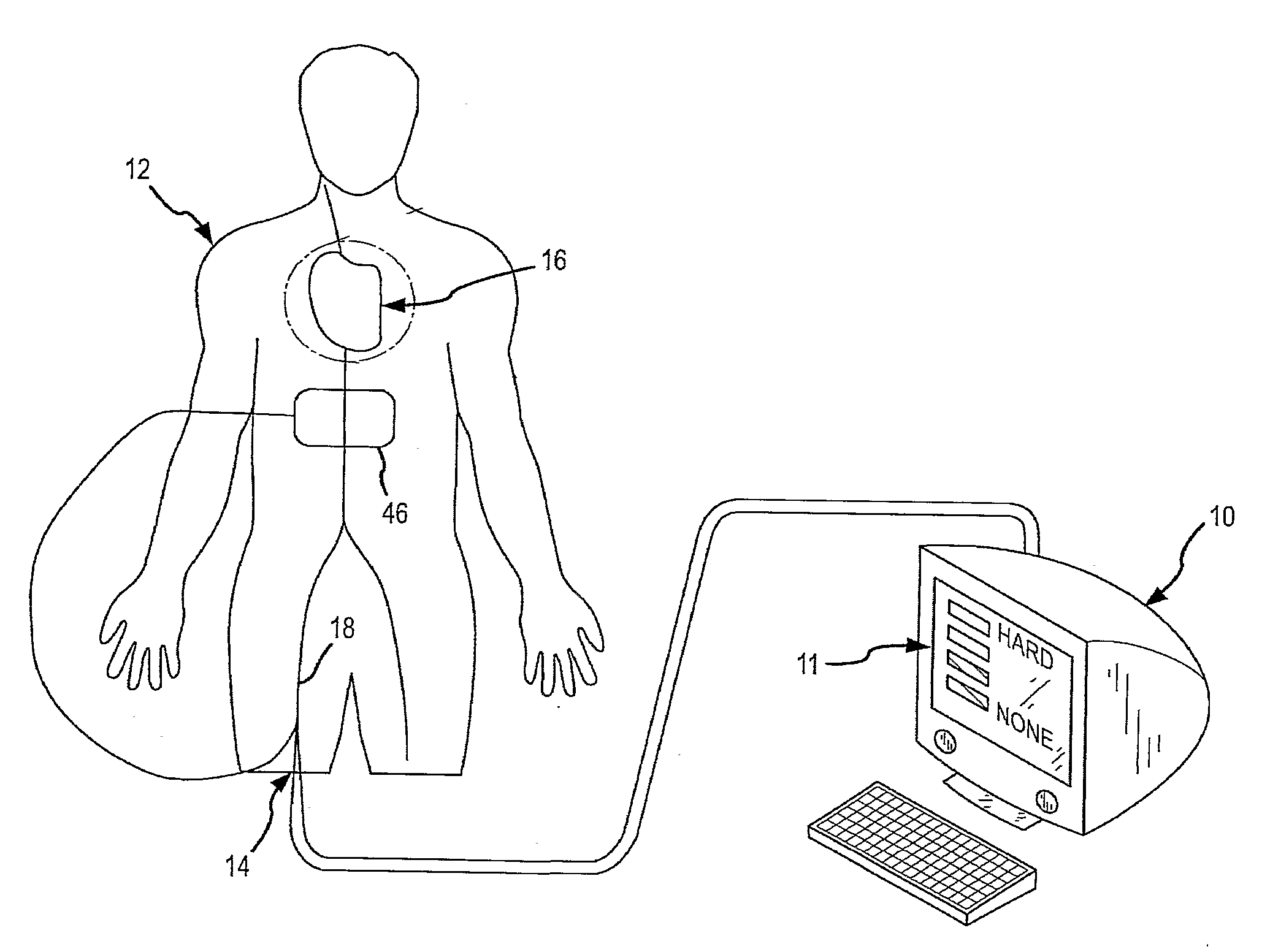 Design of Handle Set for Ablation Catheter with Indicators of Catheter and Tissue Parameters