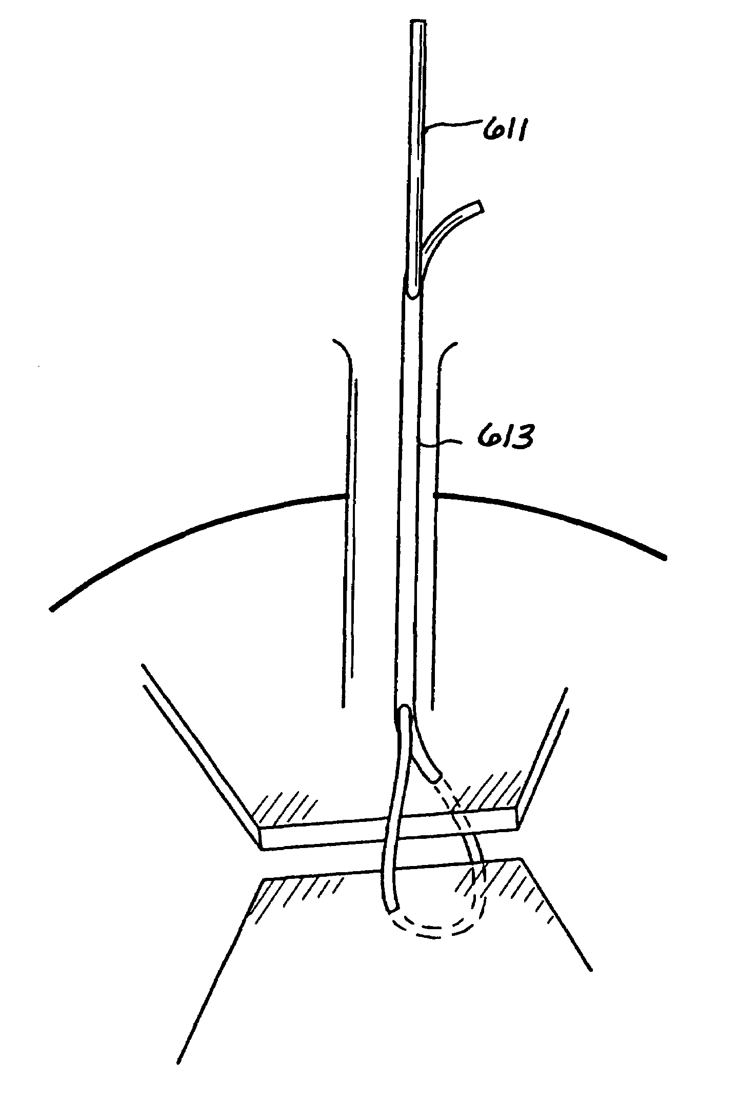 Single-tailed suturing method
