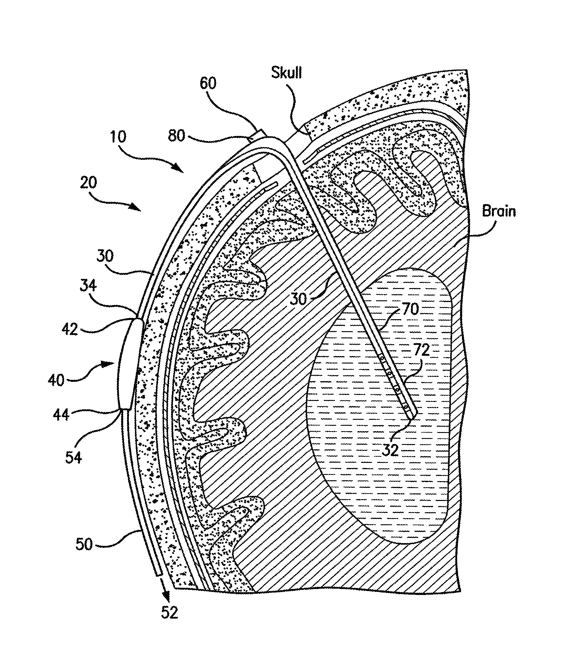 Ventricular shunt system and method