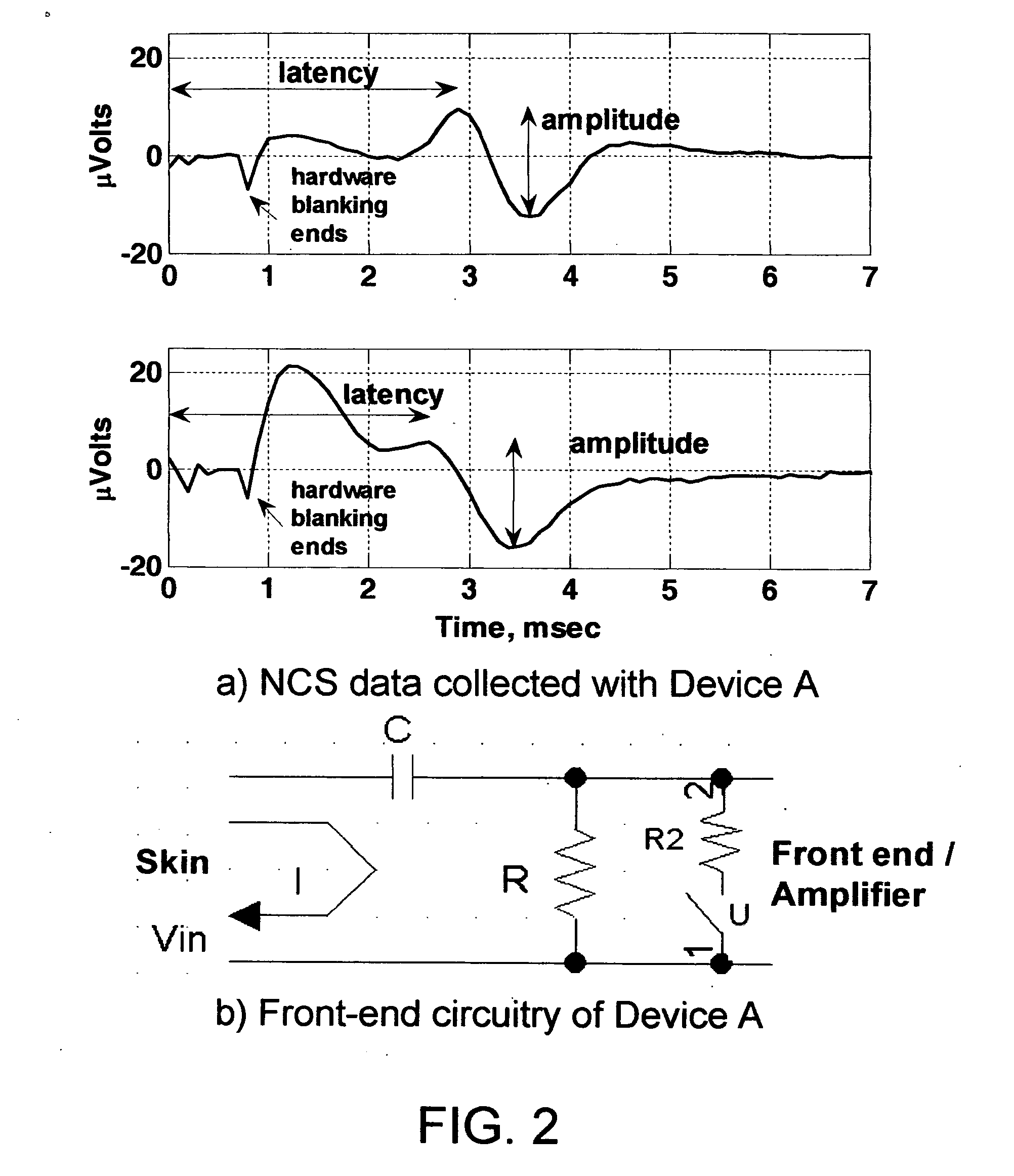 Automated stimulus artifact removal for nerve conduction studies