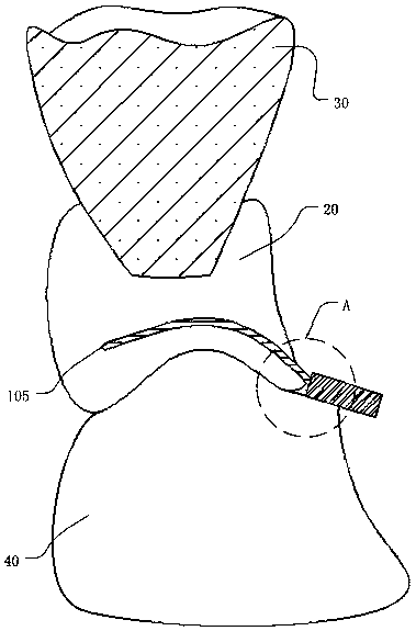 Partial denture capable of being picked off and making technology thereof