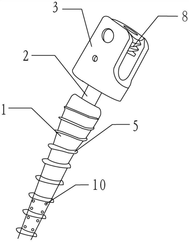 Pelvic fracture front ring fixing detachable screw and internal fixing device