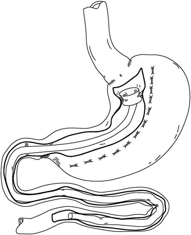 Endolumenal esophageal restriction device