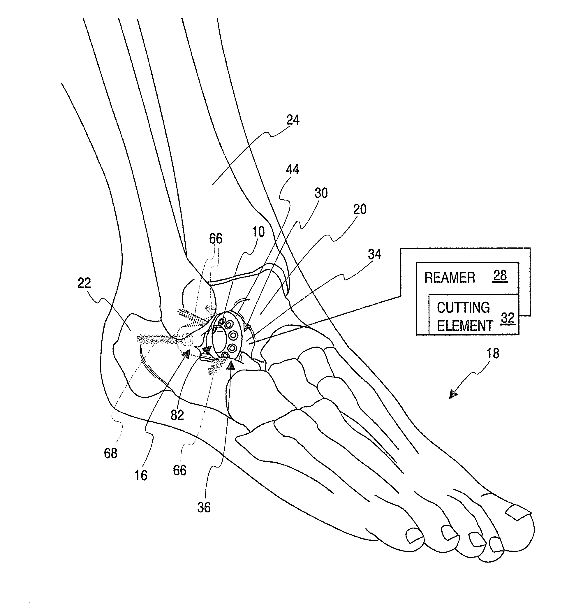 Implant for fixation of first and second bones and method of fixing first and second bones using the implant