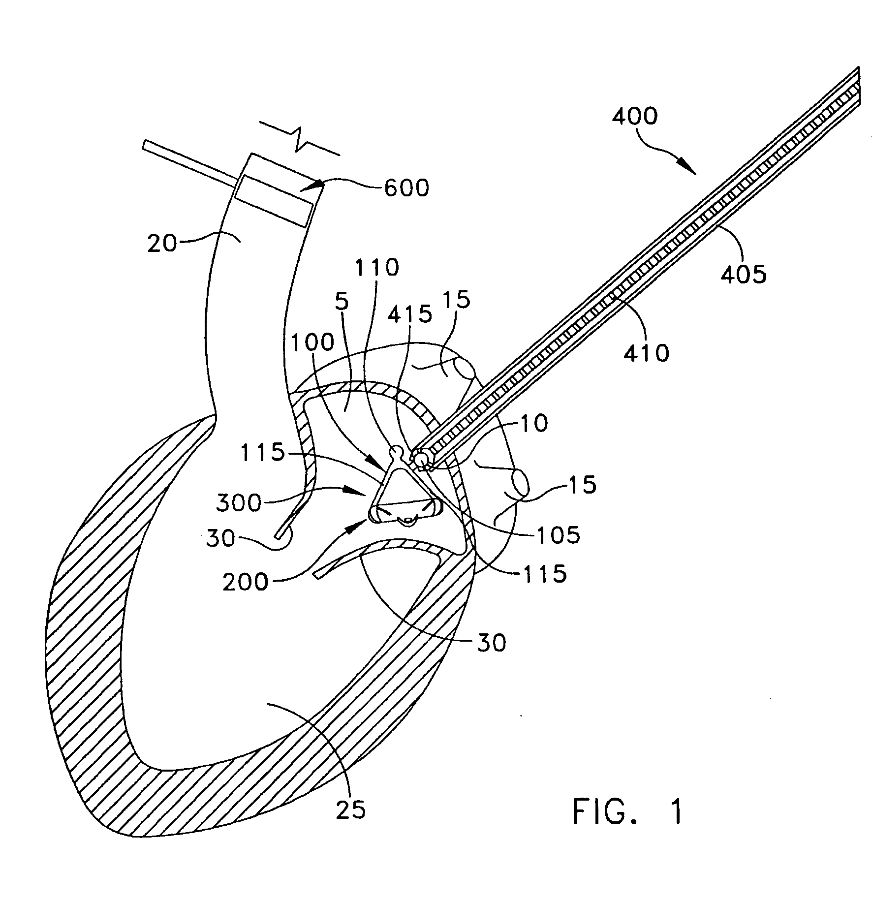 Method and apparatus for performing a procedure on a cardiac valve