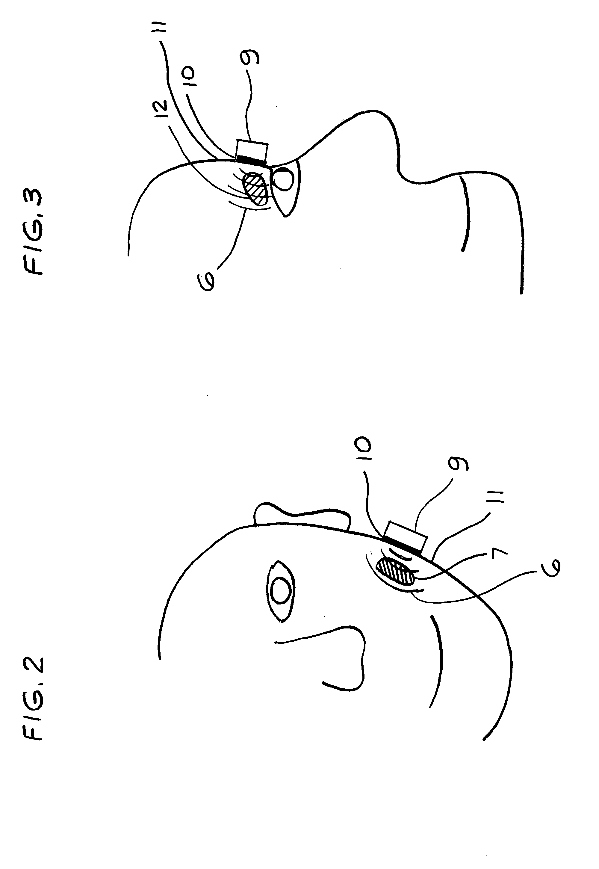 Method for increasing saliva and tear production with ultrasound