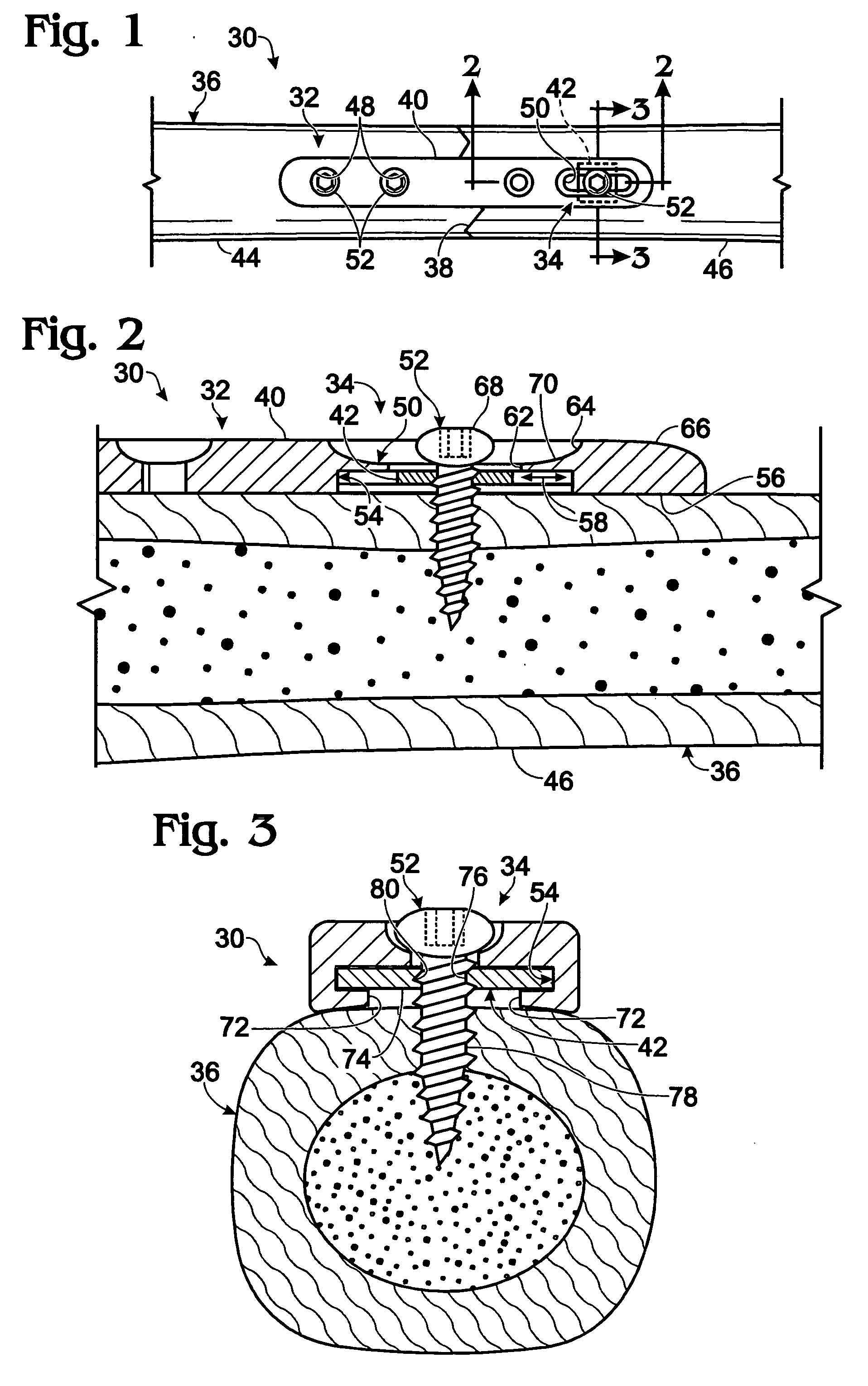 Bone plates with movable locking elements