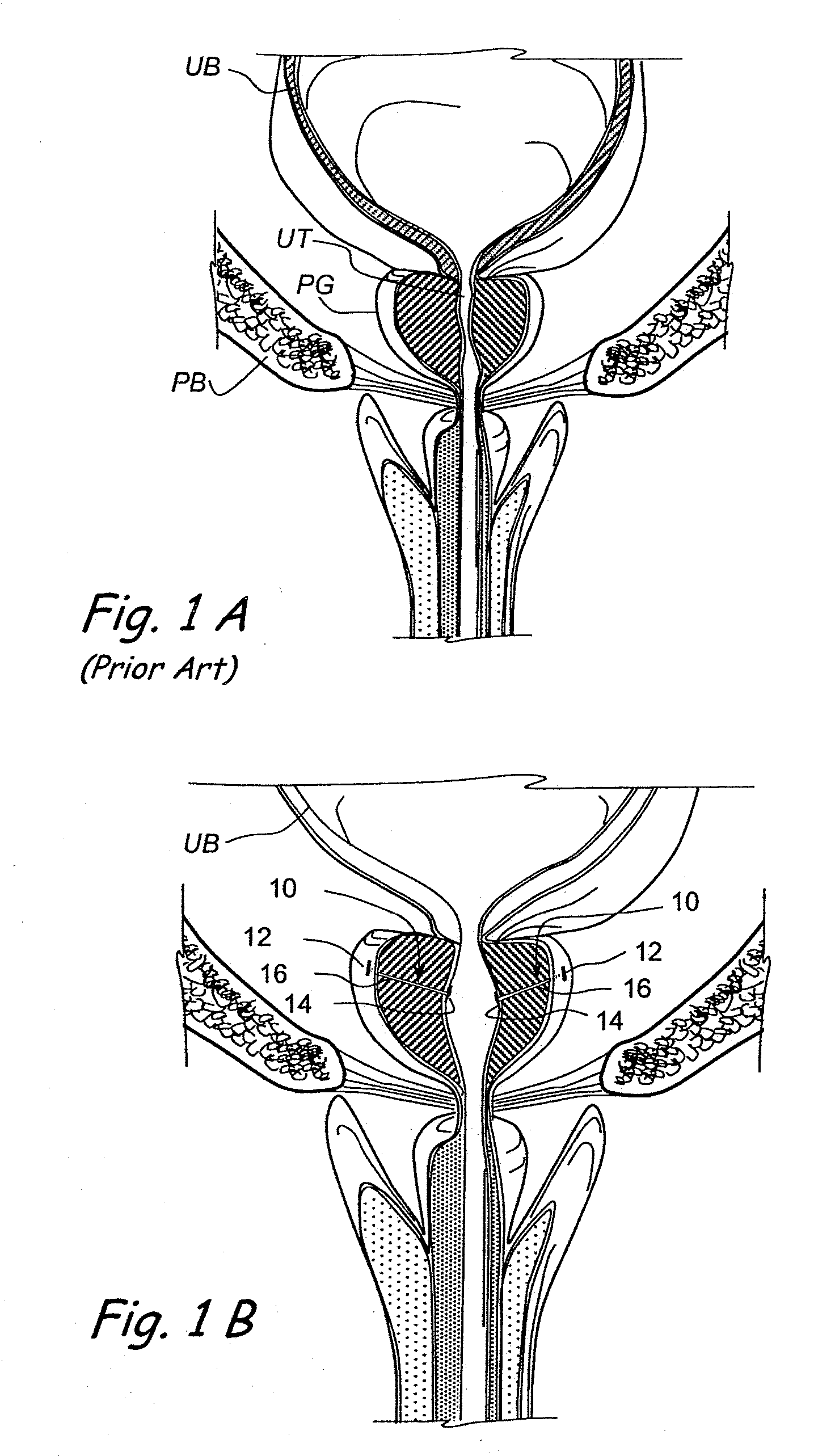 Devices, systems and methods for retracting, lifting, compressing, supporting or repositioning tissues or anatomical structures