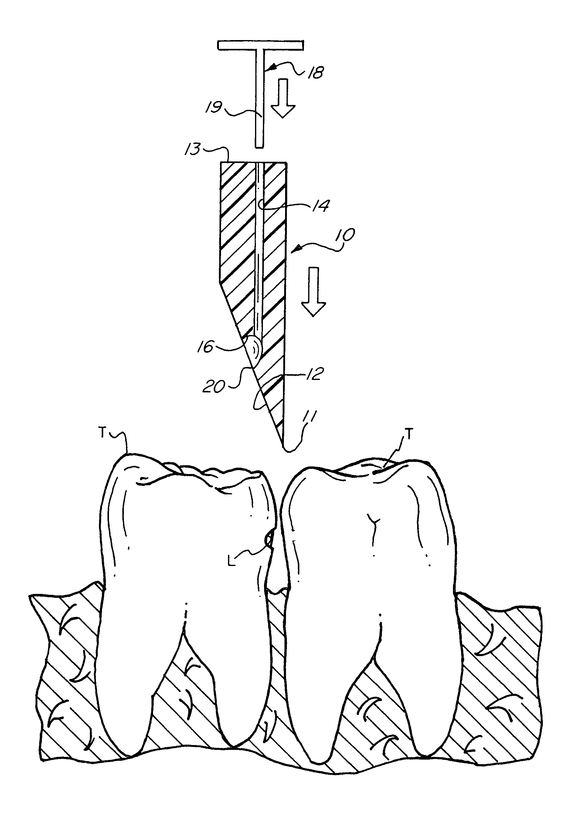 Interproximal non-surgical caries treatment device and method