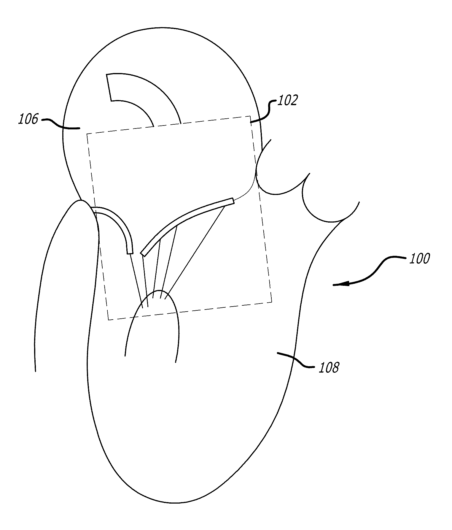 Methods and systems for heart valve therapy