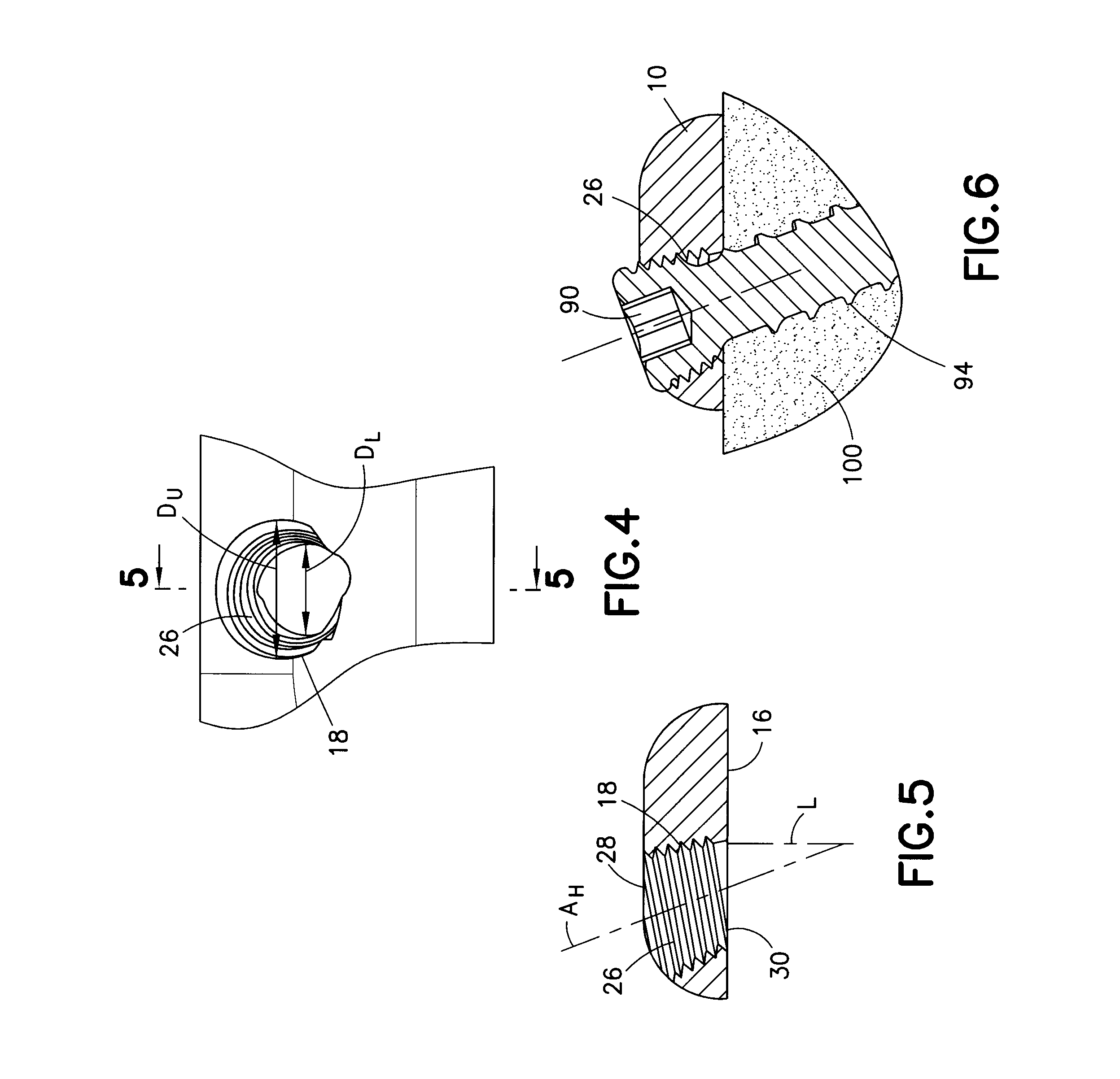 Reduced component bone plating system
