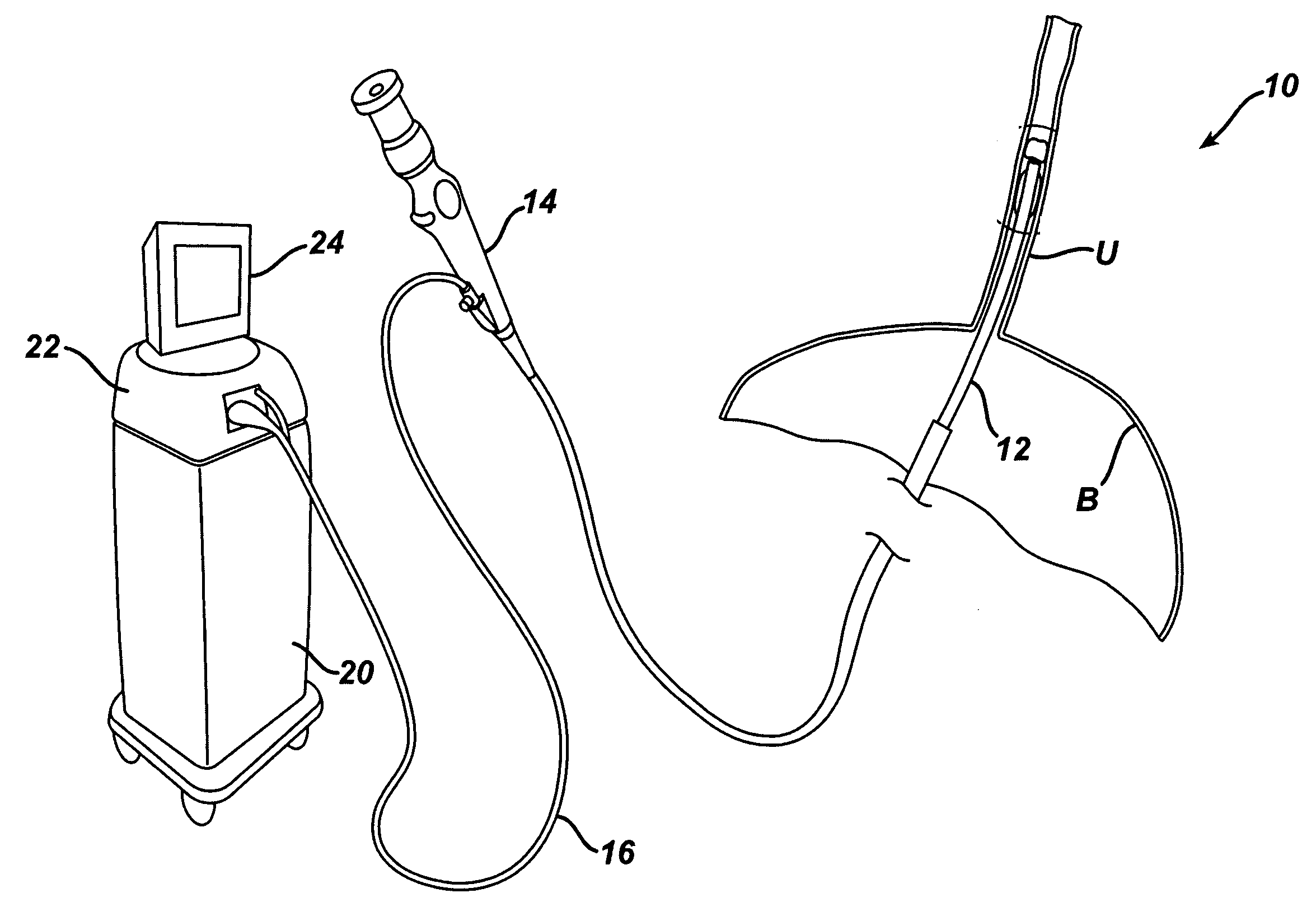 Ultrasonic device and method for treating stones within the body
